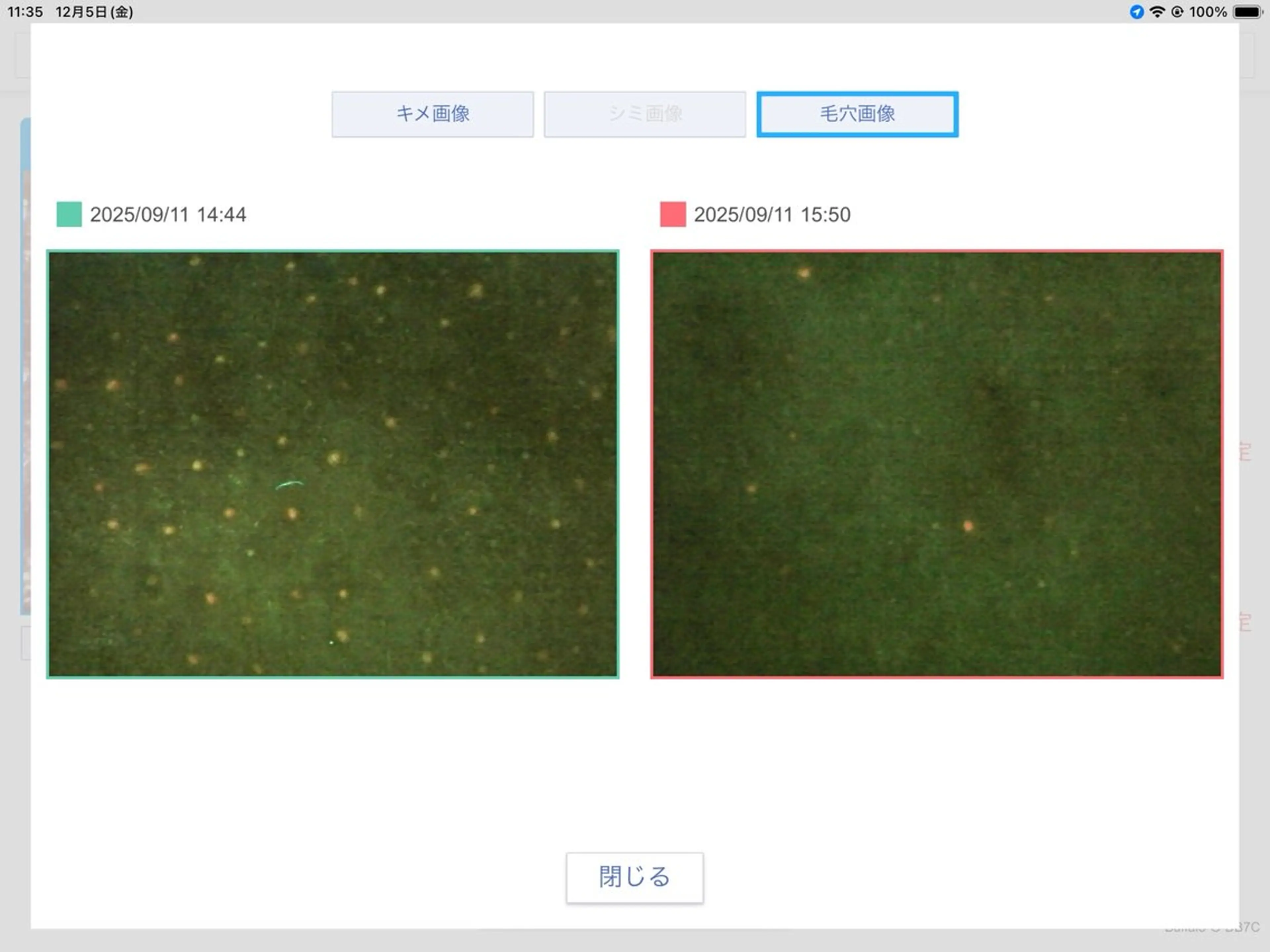 【先着10名】【口コミ投稿必須】毛穴洗浄したい！肌質知りたい！毛穴洗浄+毛穴カメラ診断📷初回限定¥13200→2980の写真