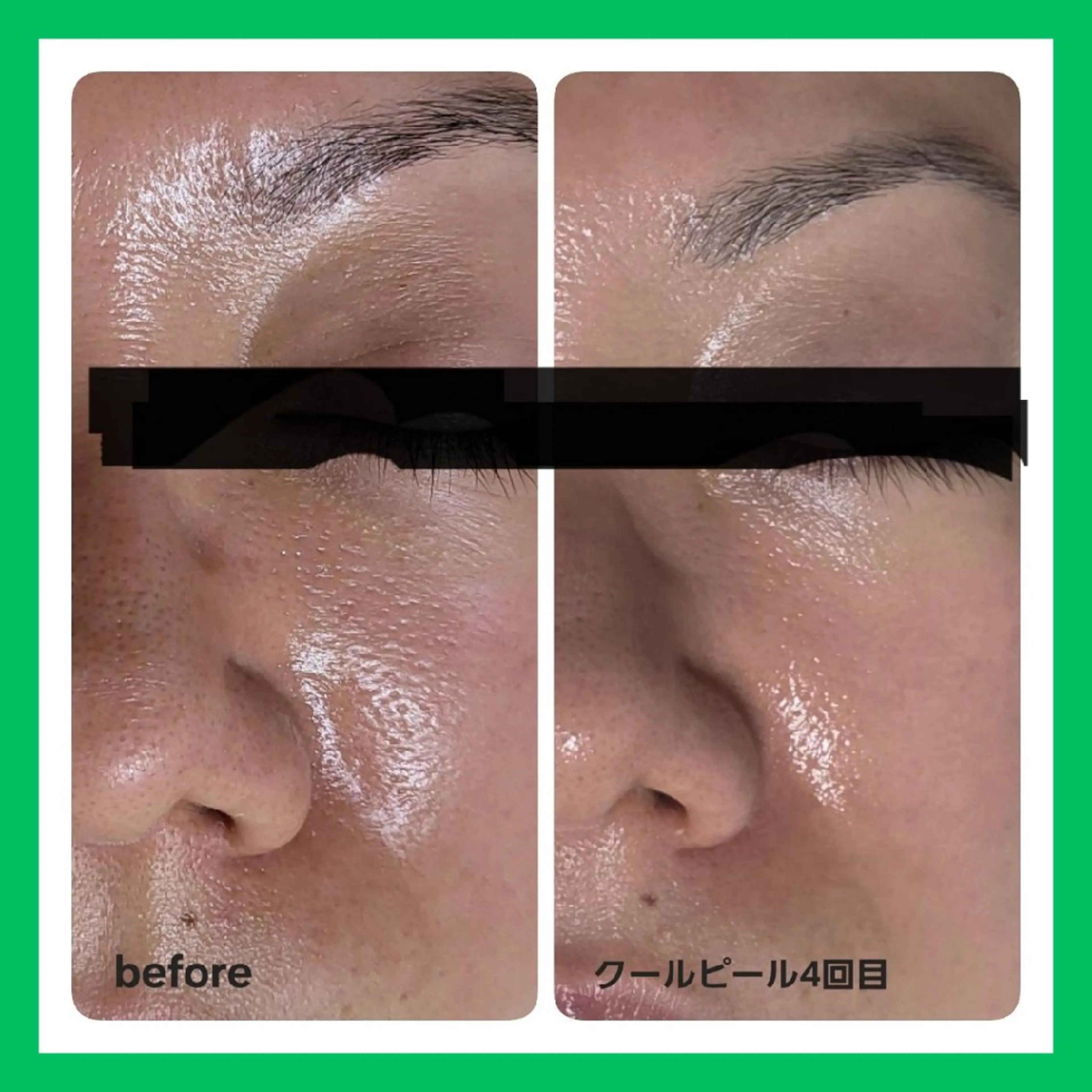 毛穴ケア・毛穴引締&トーンUP✨ダウンタイムなしのピーリング+レチノール +ビタミンCイオン導入🫧 1回9,000円の写真