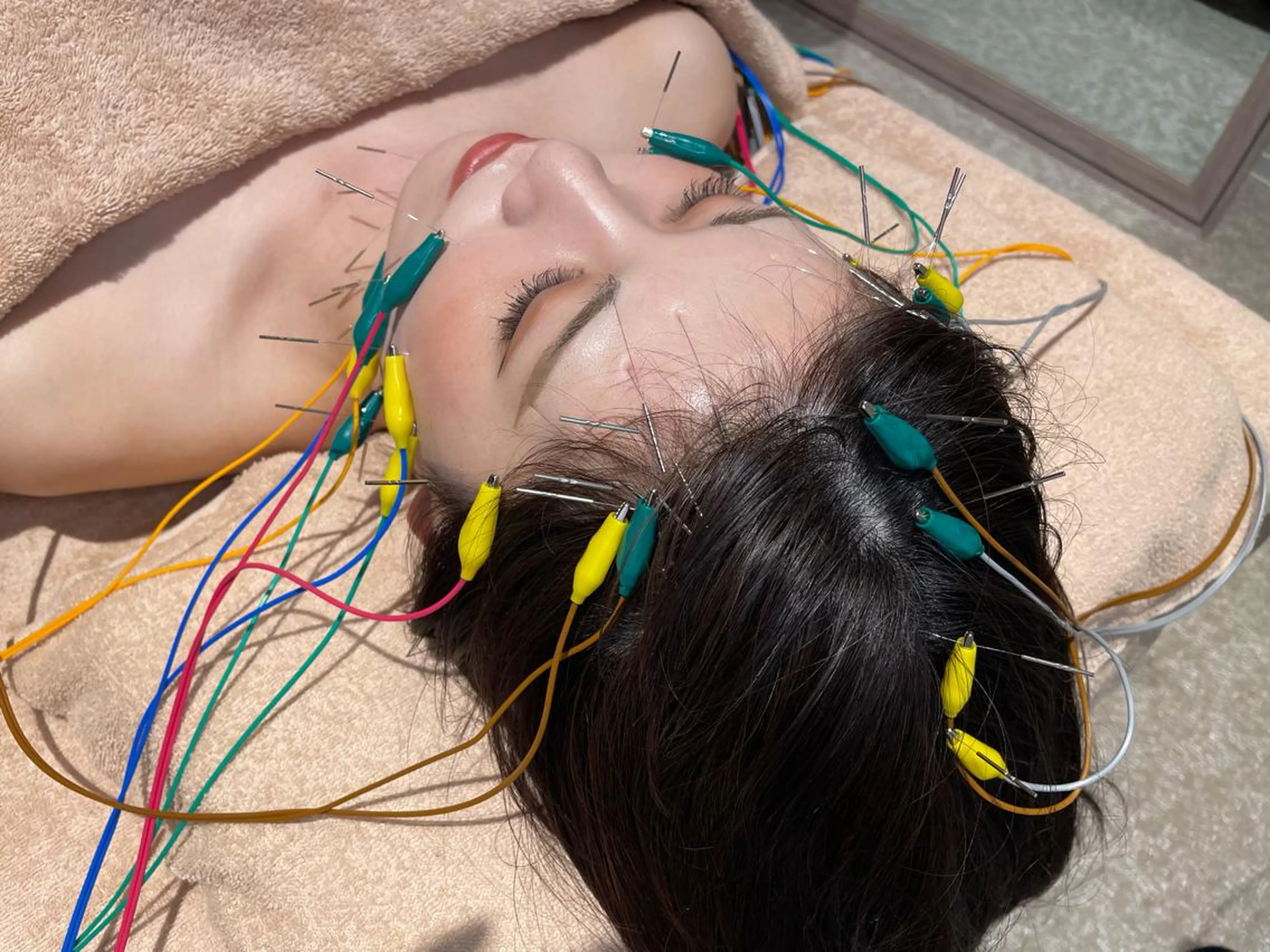 初回限定❗️電気美容鍼50本＋首、お顔、頭皮マッサージ付き【リフトアップ、たるみ、むくみ、エラの張りが気になる方向け✨】の写真
