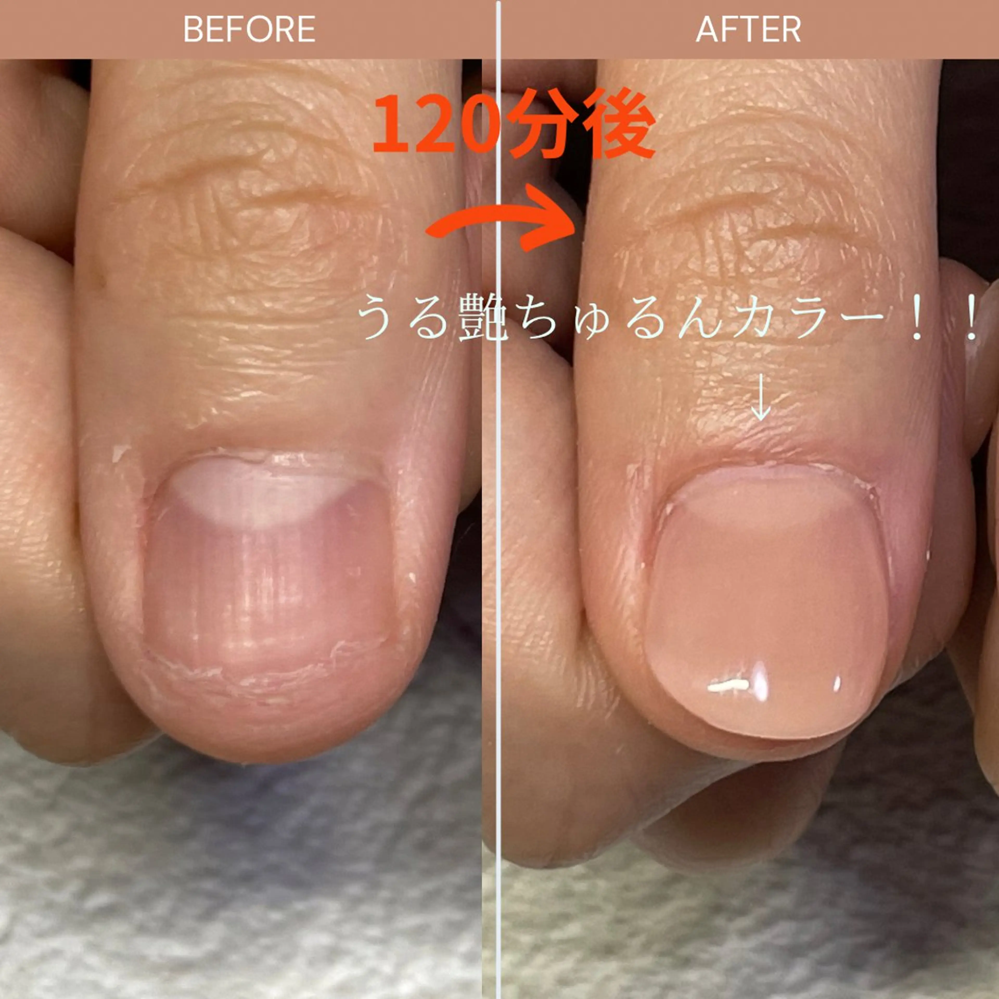 【オフなし】深爪矯正50％オフの写真