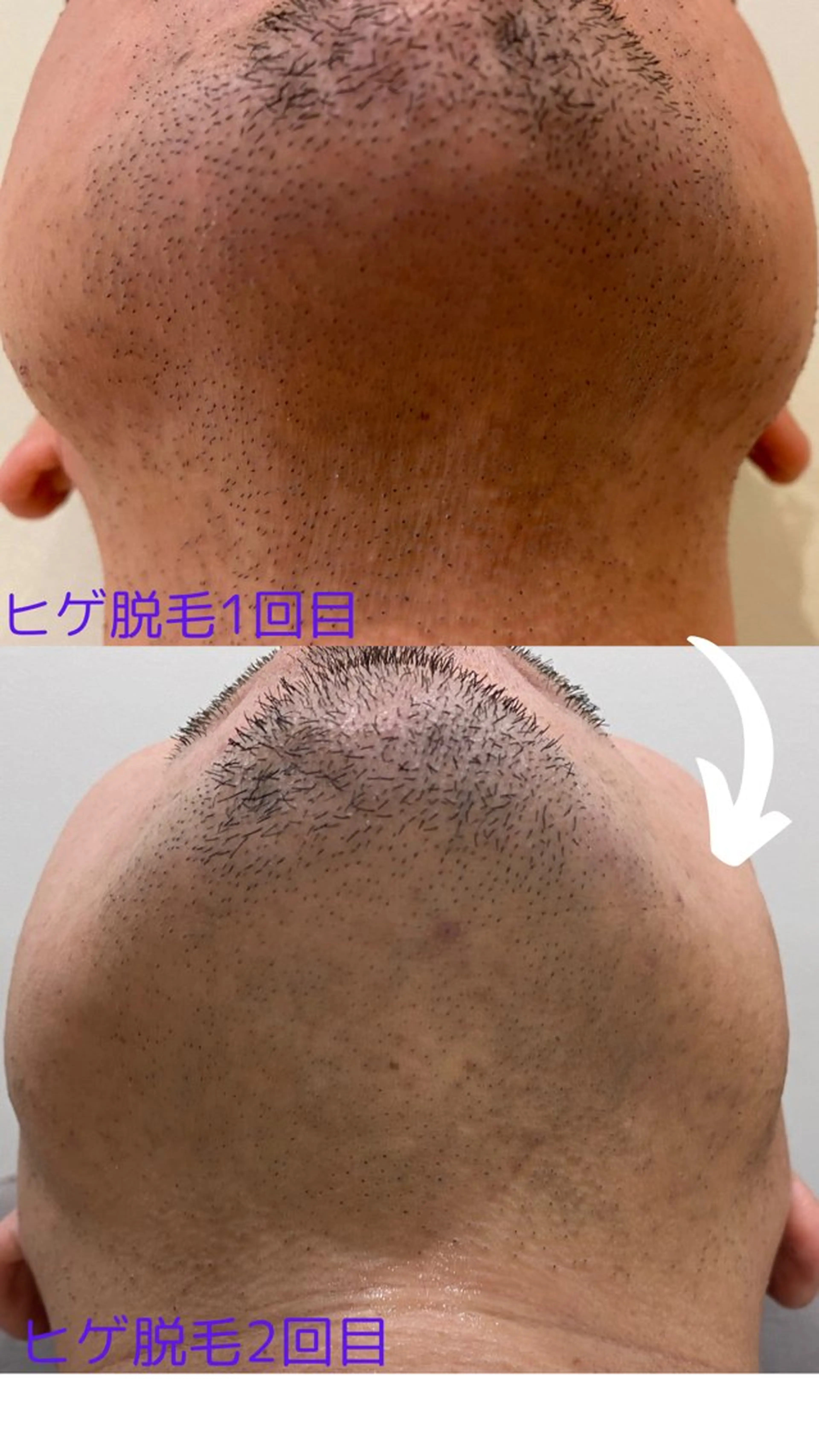 脱毛 varyclue NORIKOのエステ・リラクイメージ