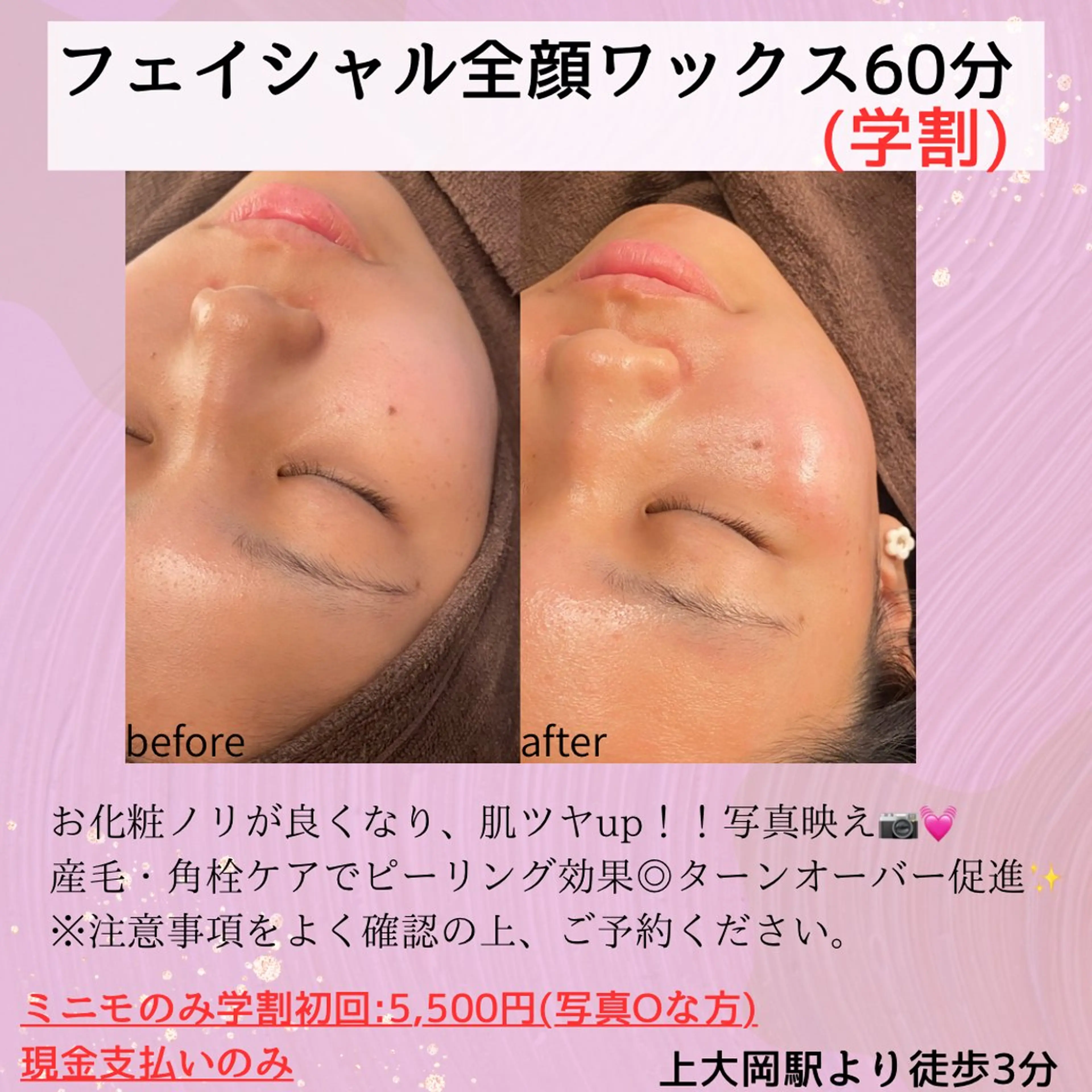 ミニモ学割🌸フェイシャル全顔ワックス✨産毛や角質ケアができピーリング効果◎お化粧ノリ・ツヤupで写真映え💖の写真