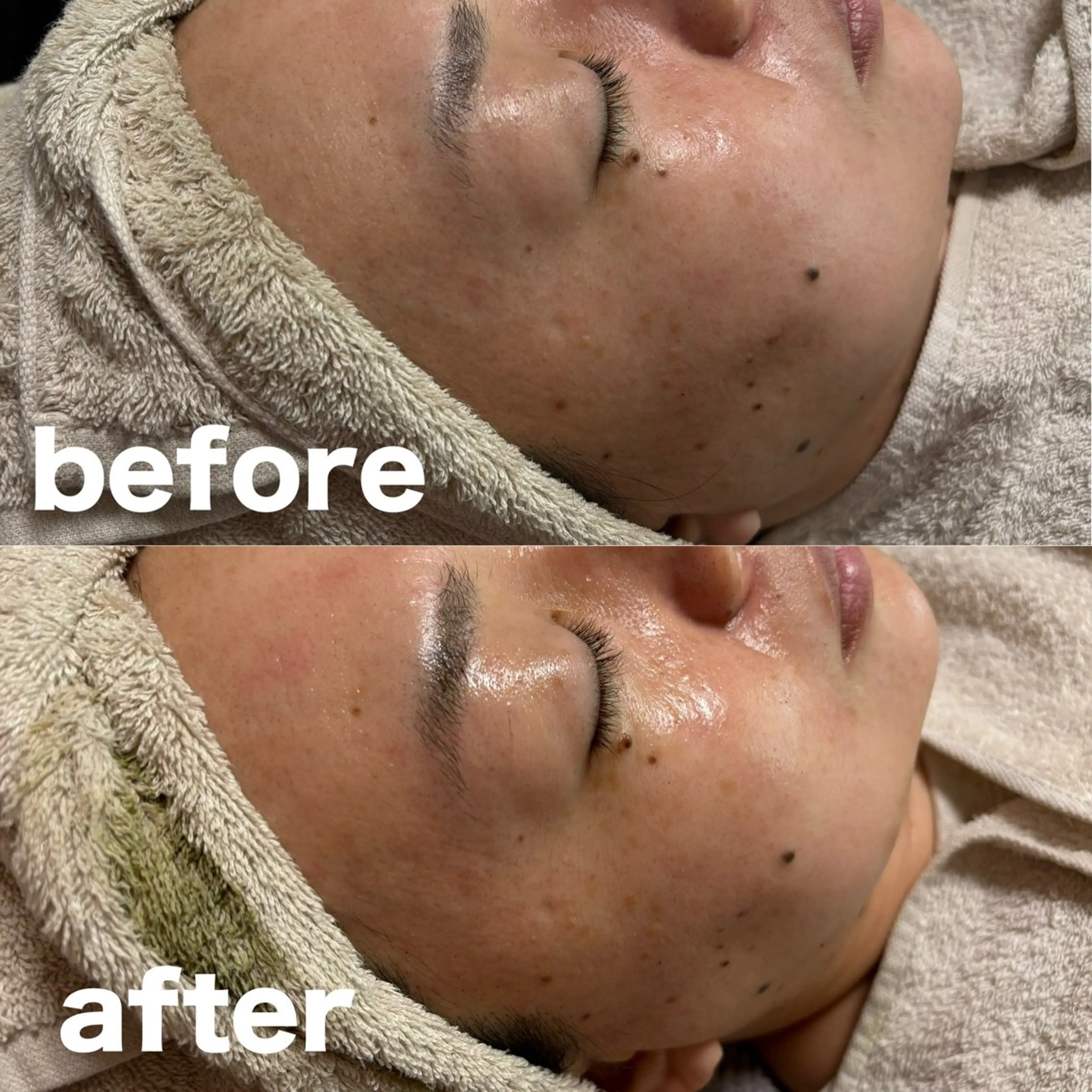 エステ 肌質改善 陶器肌🌿のエステ・リラクイメージ