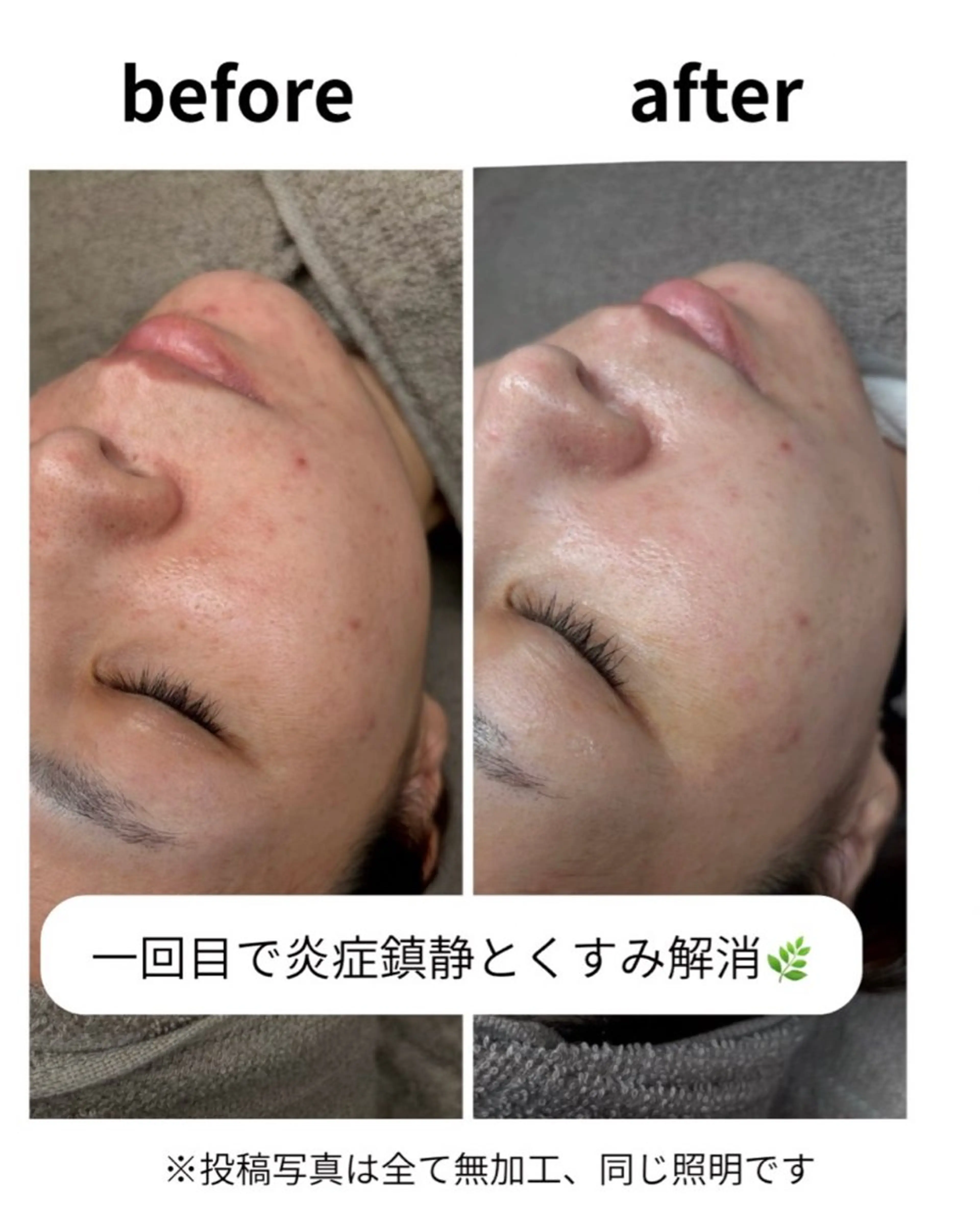 エステダーマ💉気になる肌荒れ💭ニキビを鎮静🌿メンズ◎の写真