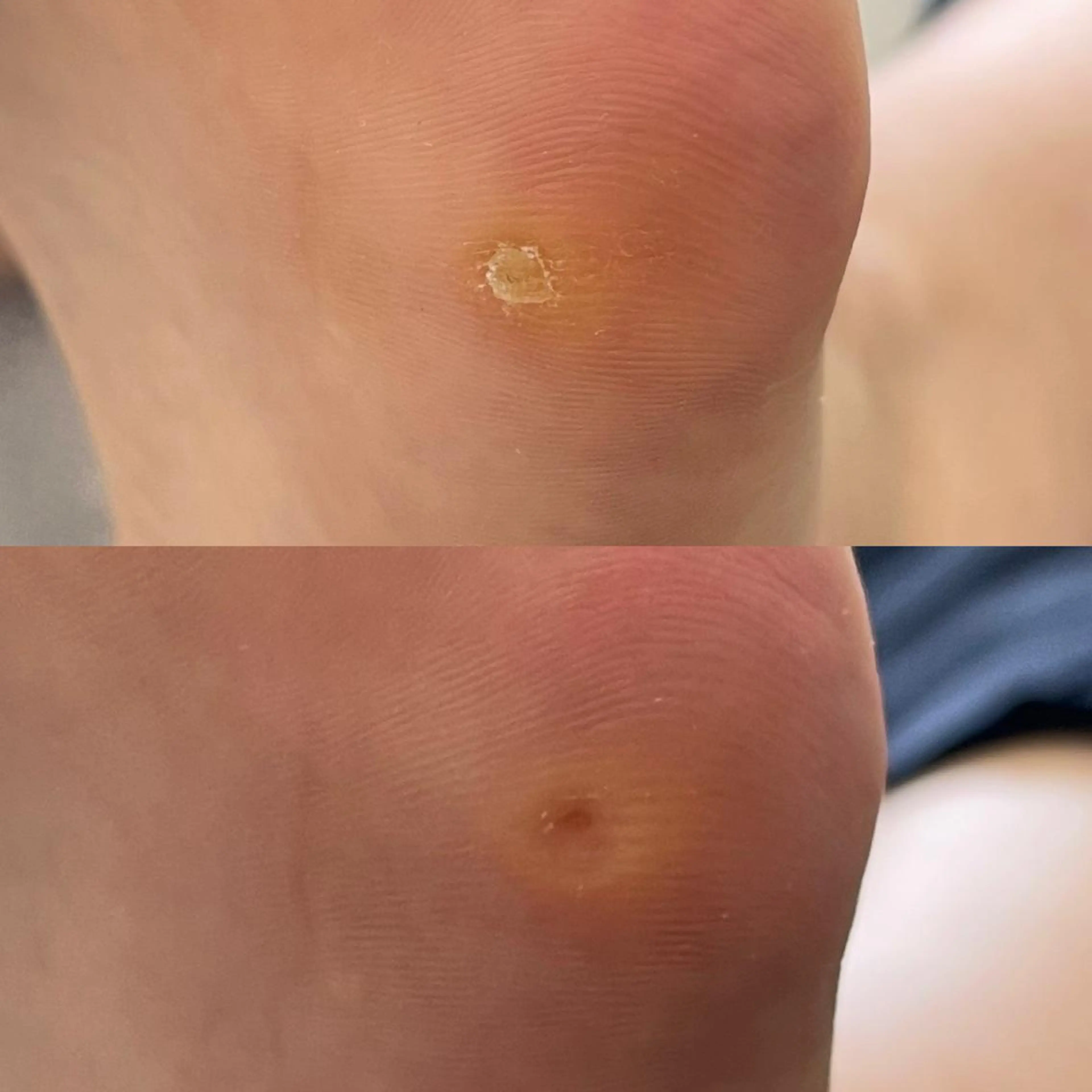 魚の目ケア　2025年7月30日の写真