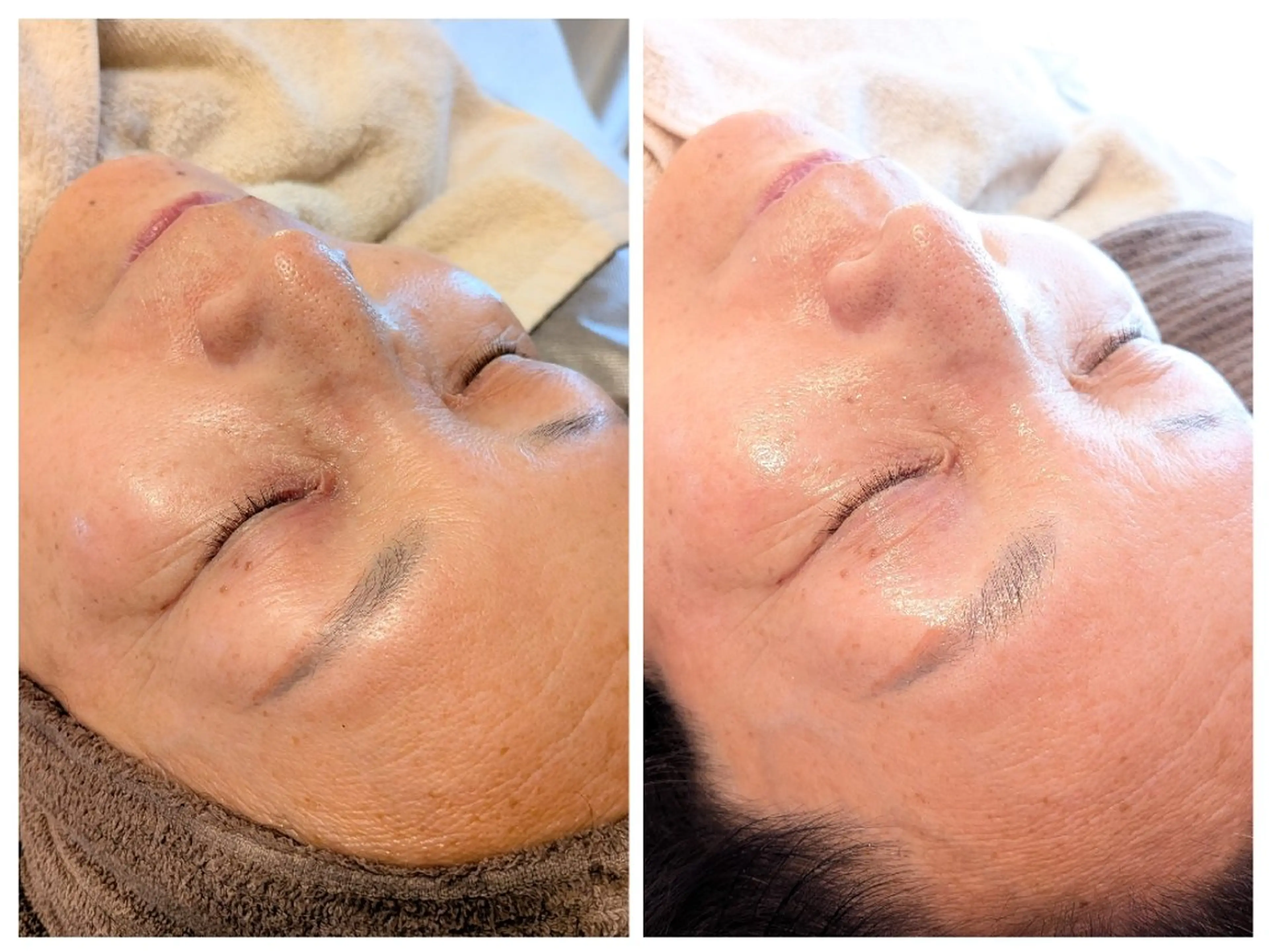 【年齢によるお悩み改善】年齢肌・高濃度浸透美容液(ヘッド付)120分の写真