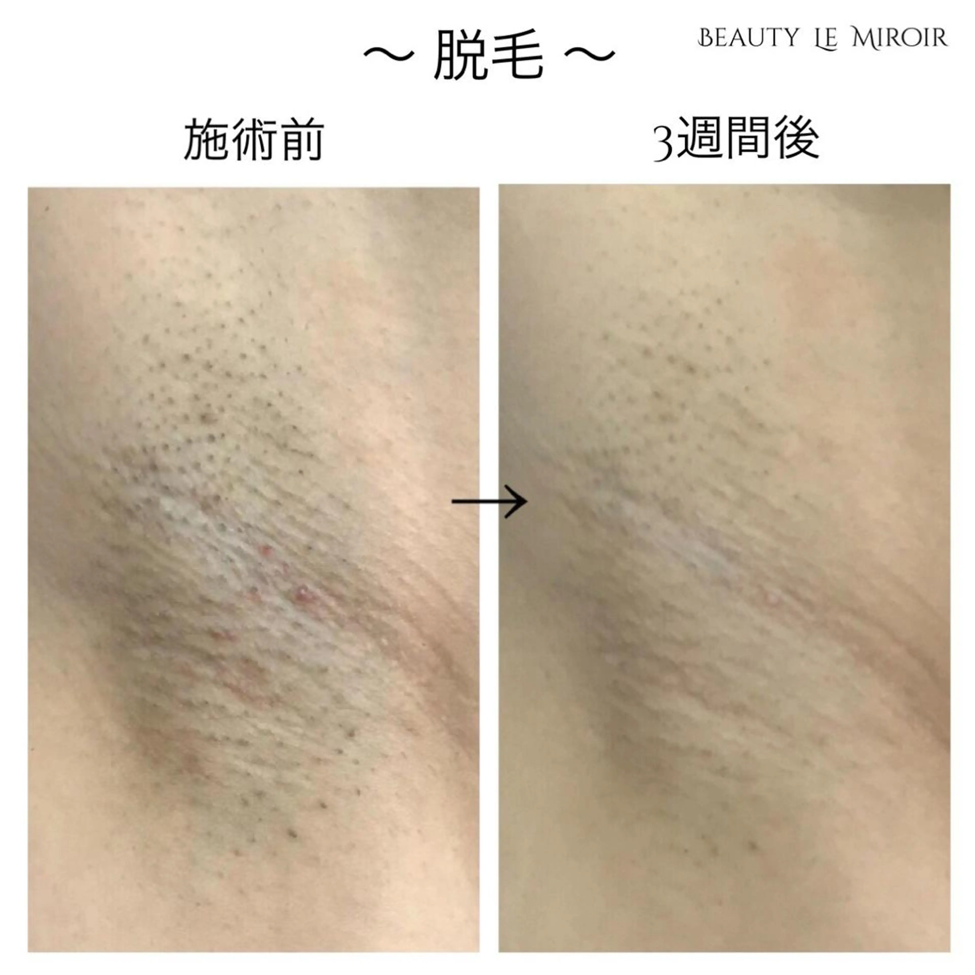 脱毛 ビューティー ミロワールのエステ・リラクイメージ