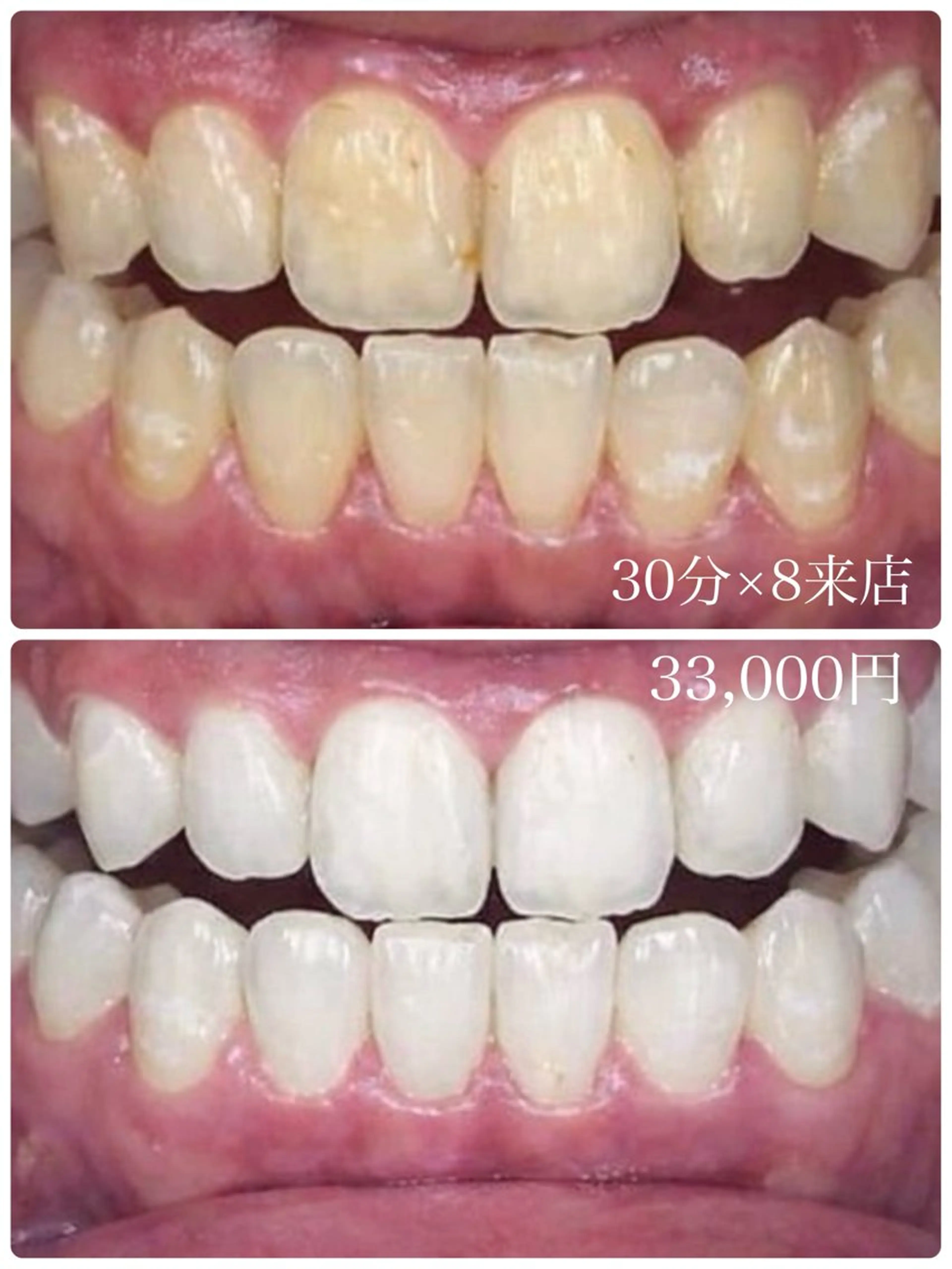 エステ プラチナムビューティー柏所属・【歯科提携】柏ホワイ トニングスタイルのその他イメージ