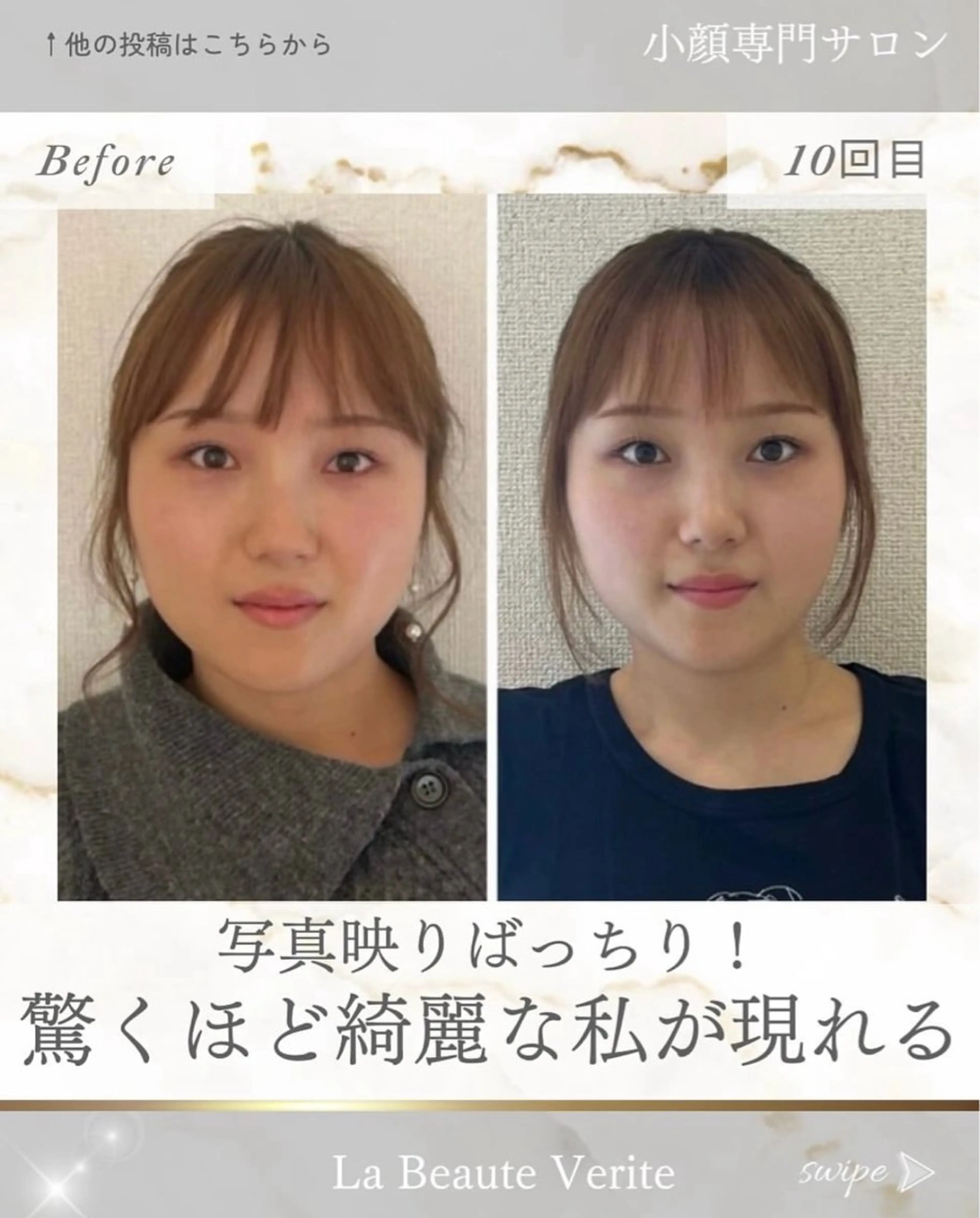 【エラ張り・顔の大きさ】痛くない小顔矯正 初回体験の写真