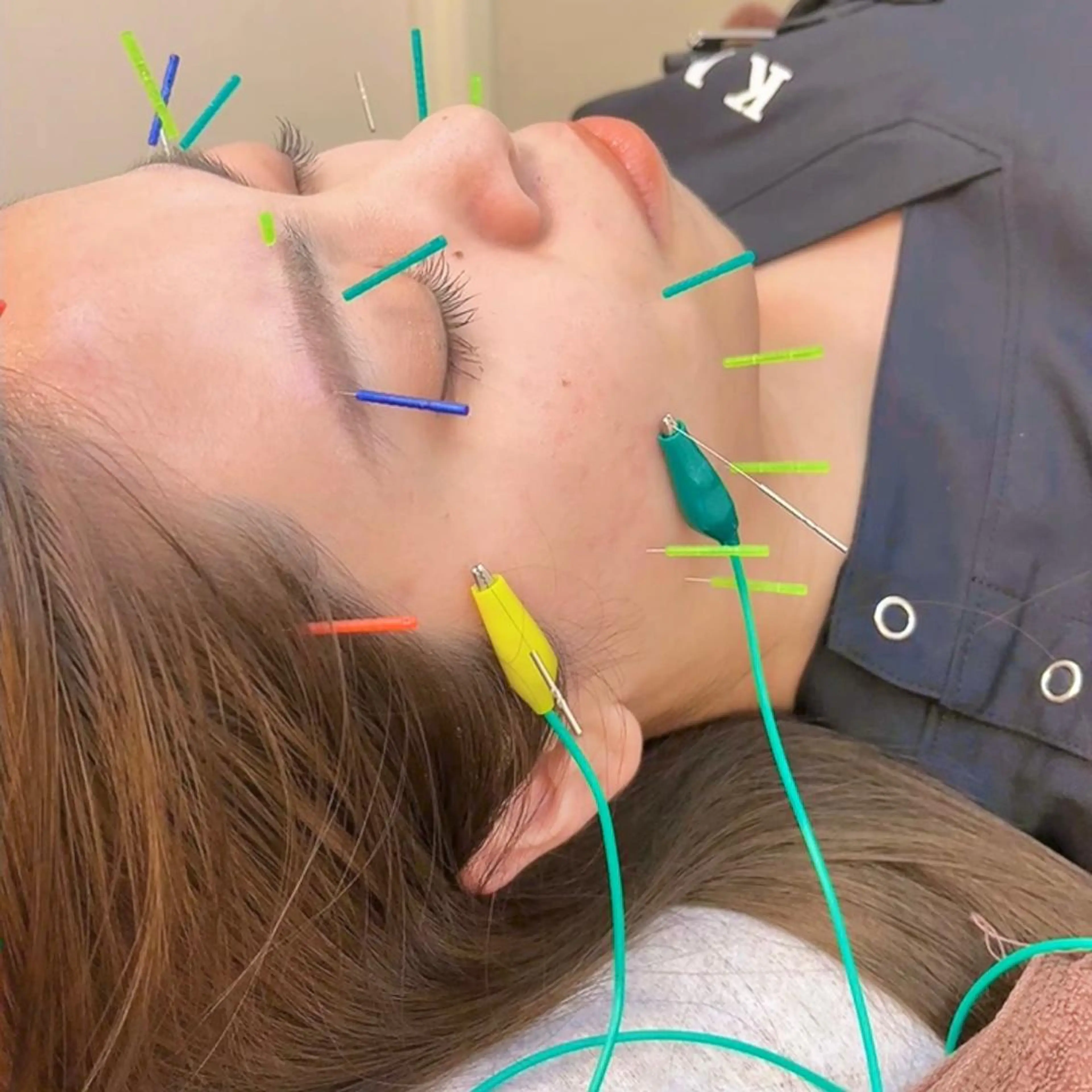 ‬【美容鍼➕小顔矯正💆🏻】むくみ,たるみ,左右差etc...様々なお顔のお悩み解決✨の写真