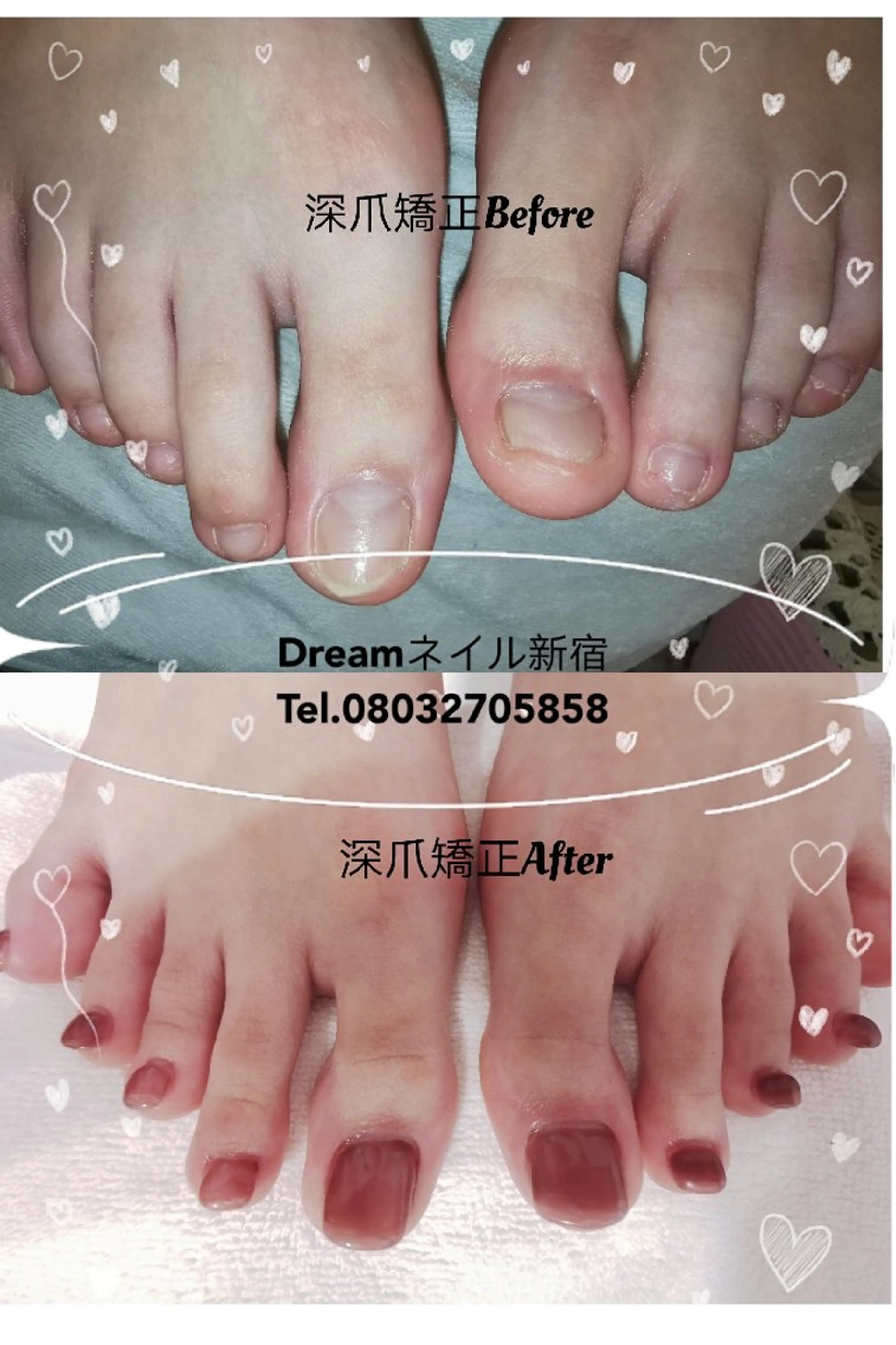 ネイル フットネイル ネイリストゆか💅 長さだし、深爪矯正のネイルデザイン