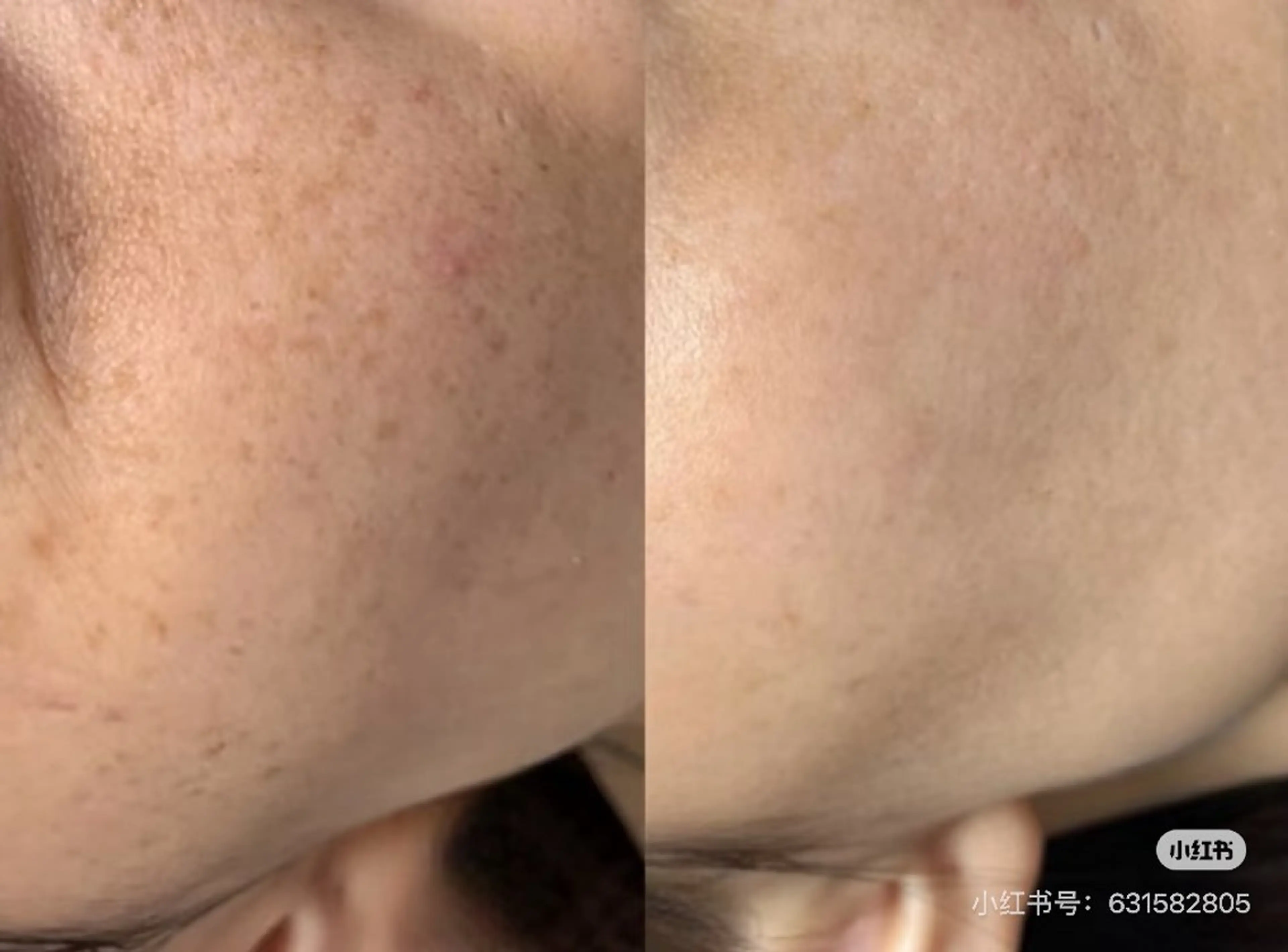 ご新規様限定☘️毛穴洗浄＆DPL光フェシャルの写真