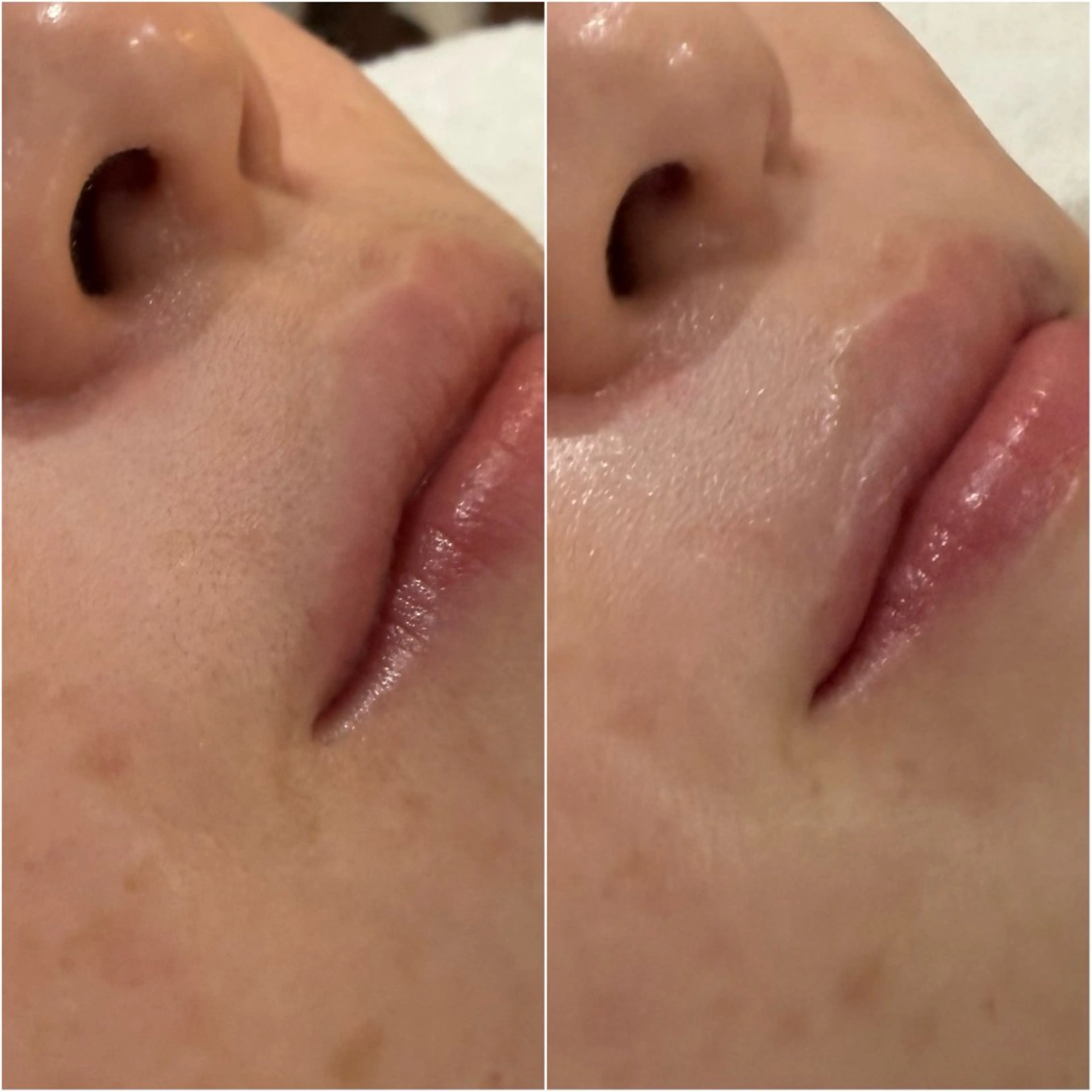 【口周りワックス】の写真