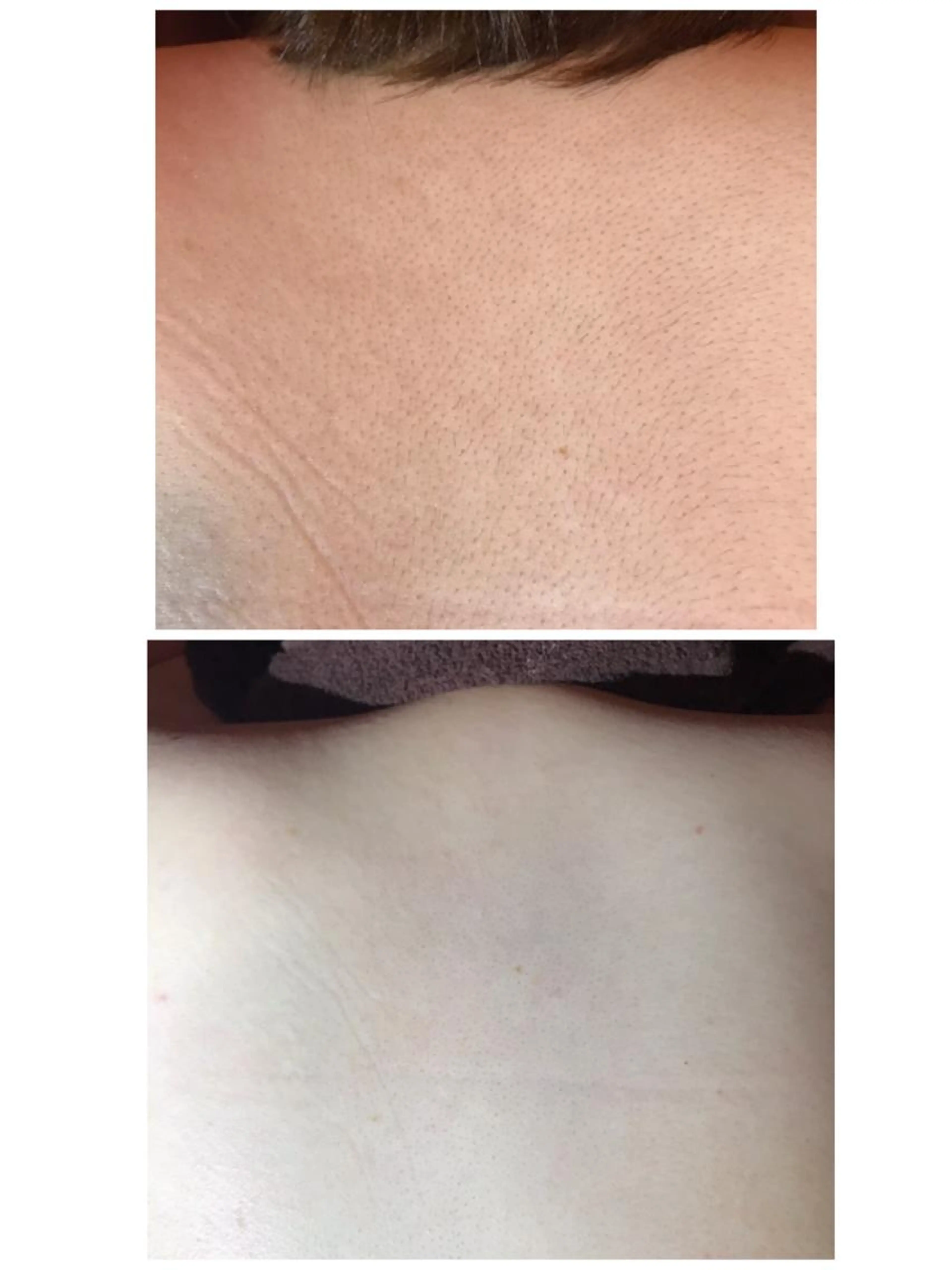 【女性wax】背中FULL ワックス脱毛の写真