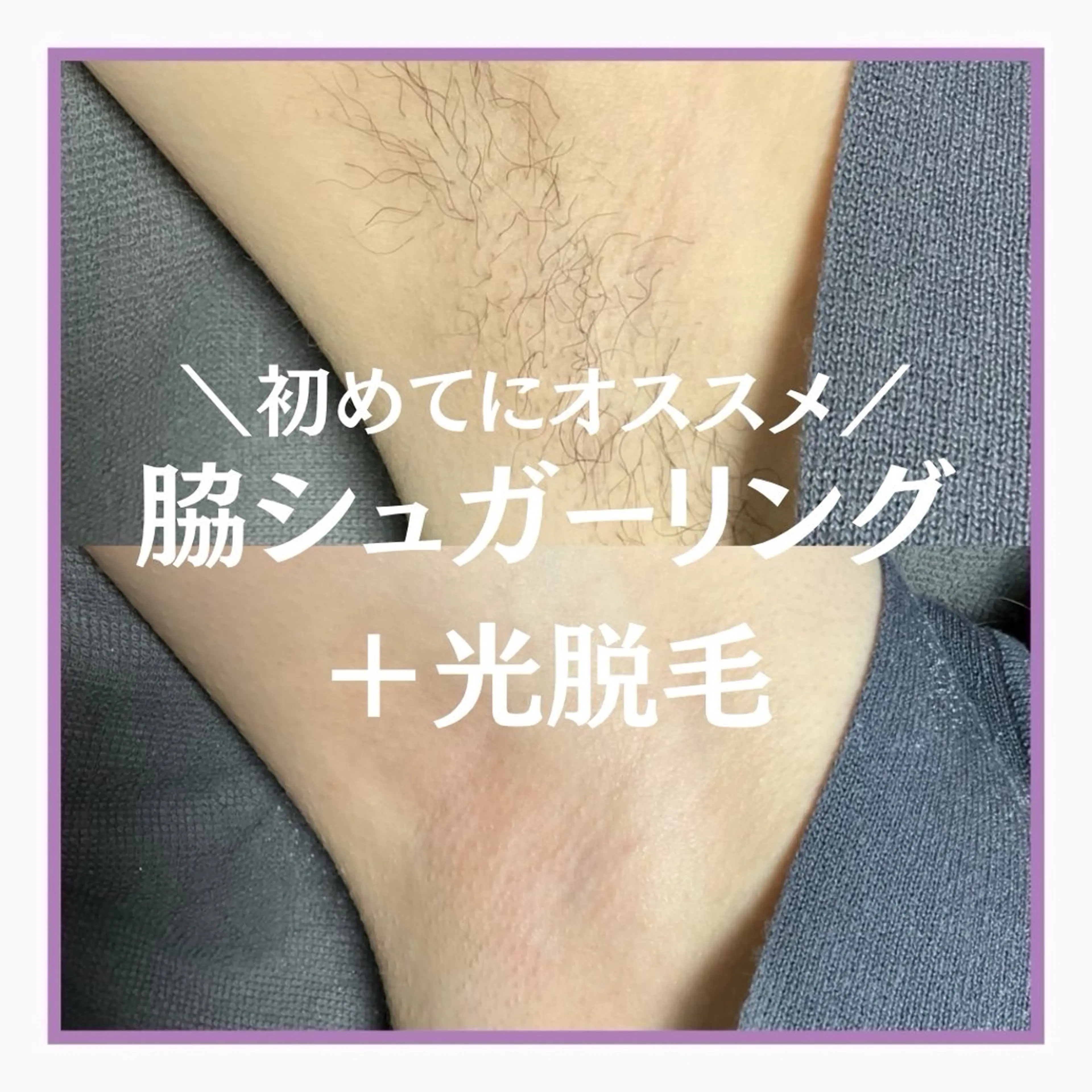 初めてにオススメ✨両脇シュガーリング+光脱毛🍋の写真