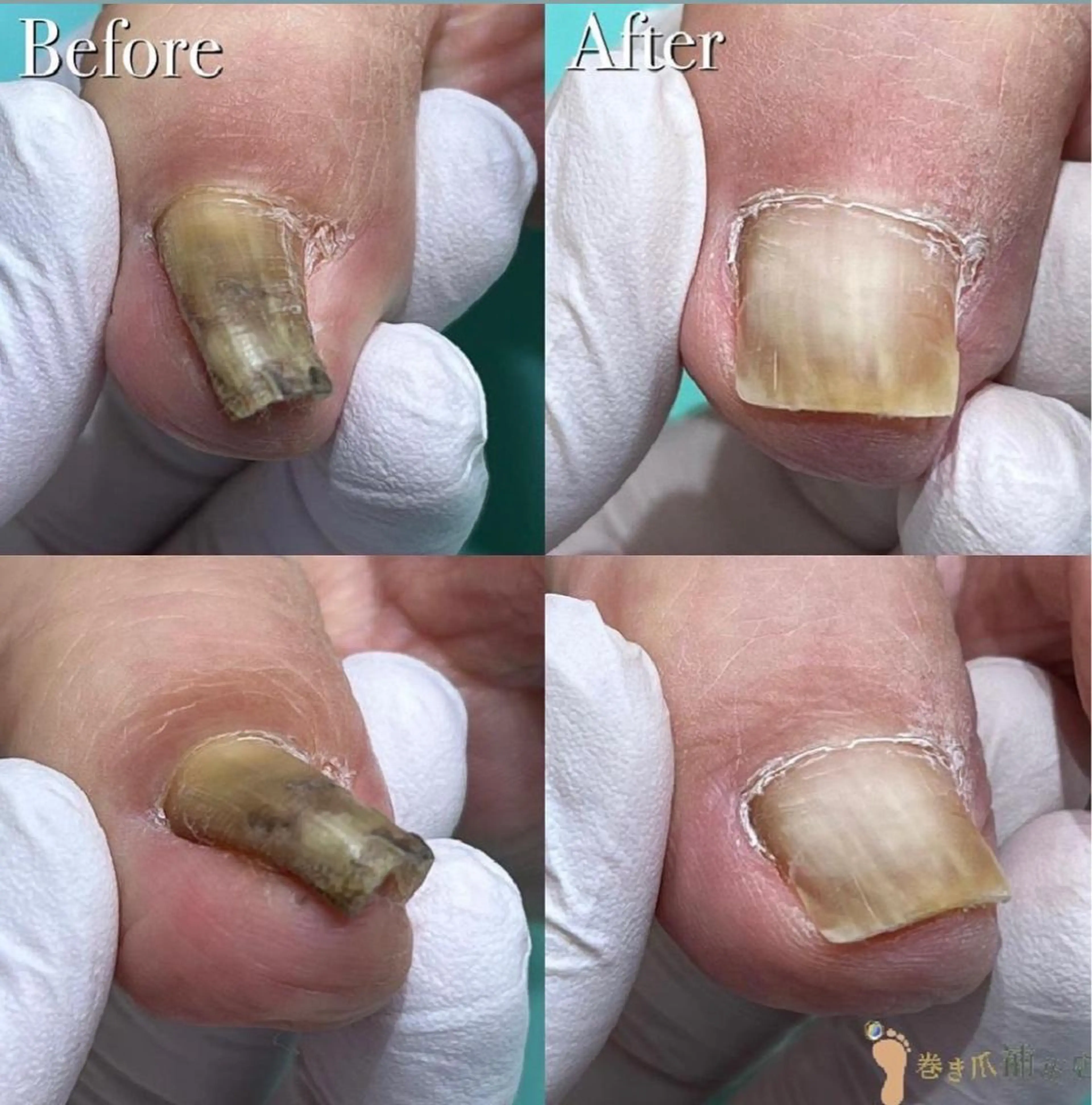 川崎巻き爪補正店所属・巻き爪アカデミー 溝の口のネイルデザイン