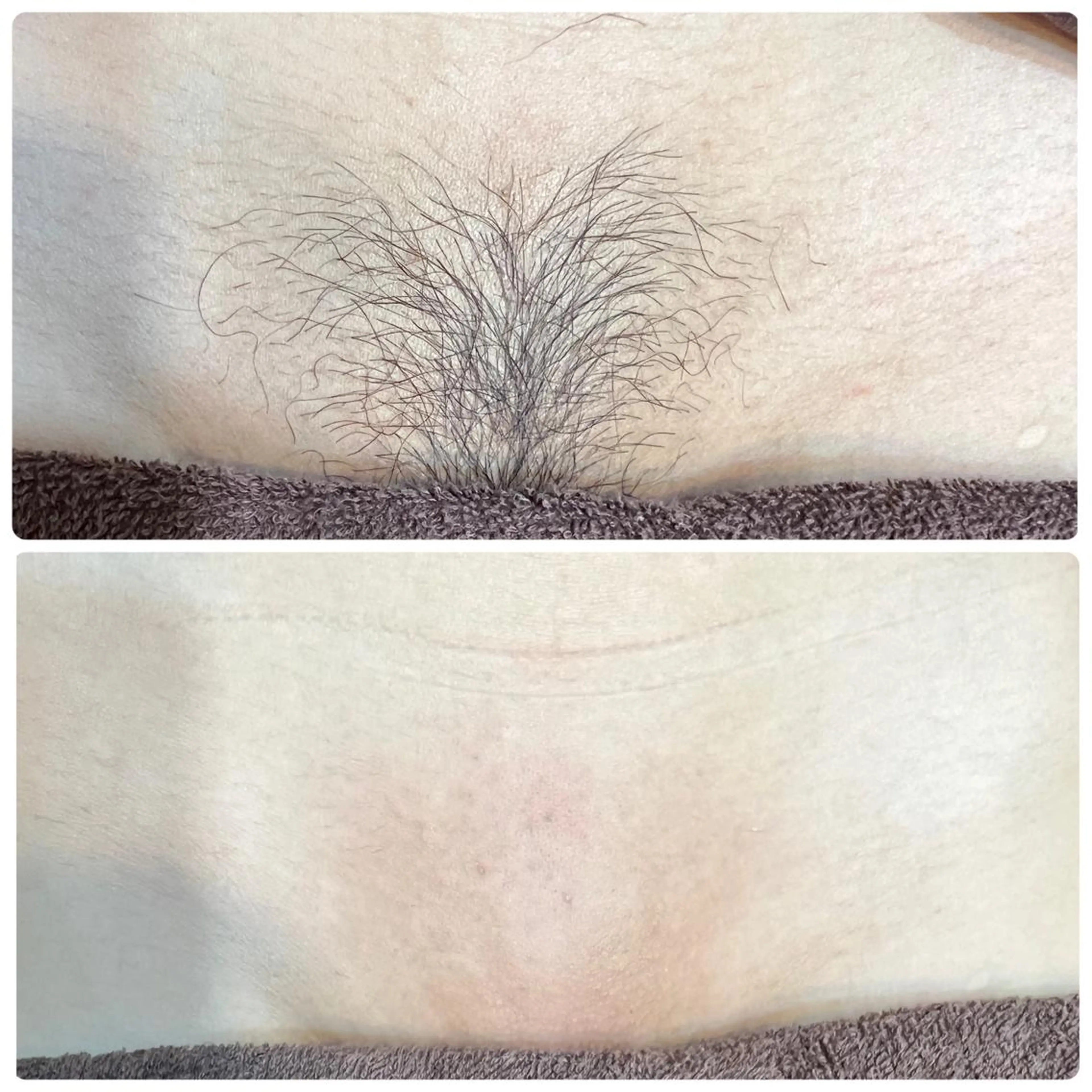 モニター様募集！即効ツルツルずっとツルツル【VIOワックス脱毛＋光脱毛】★ダブル脱毛で来店日からずっとツルスベ♪女性限定の写真