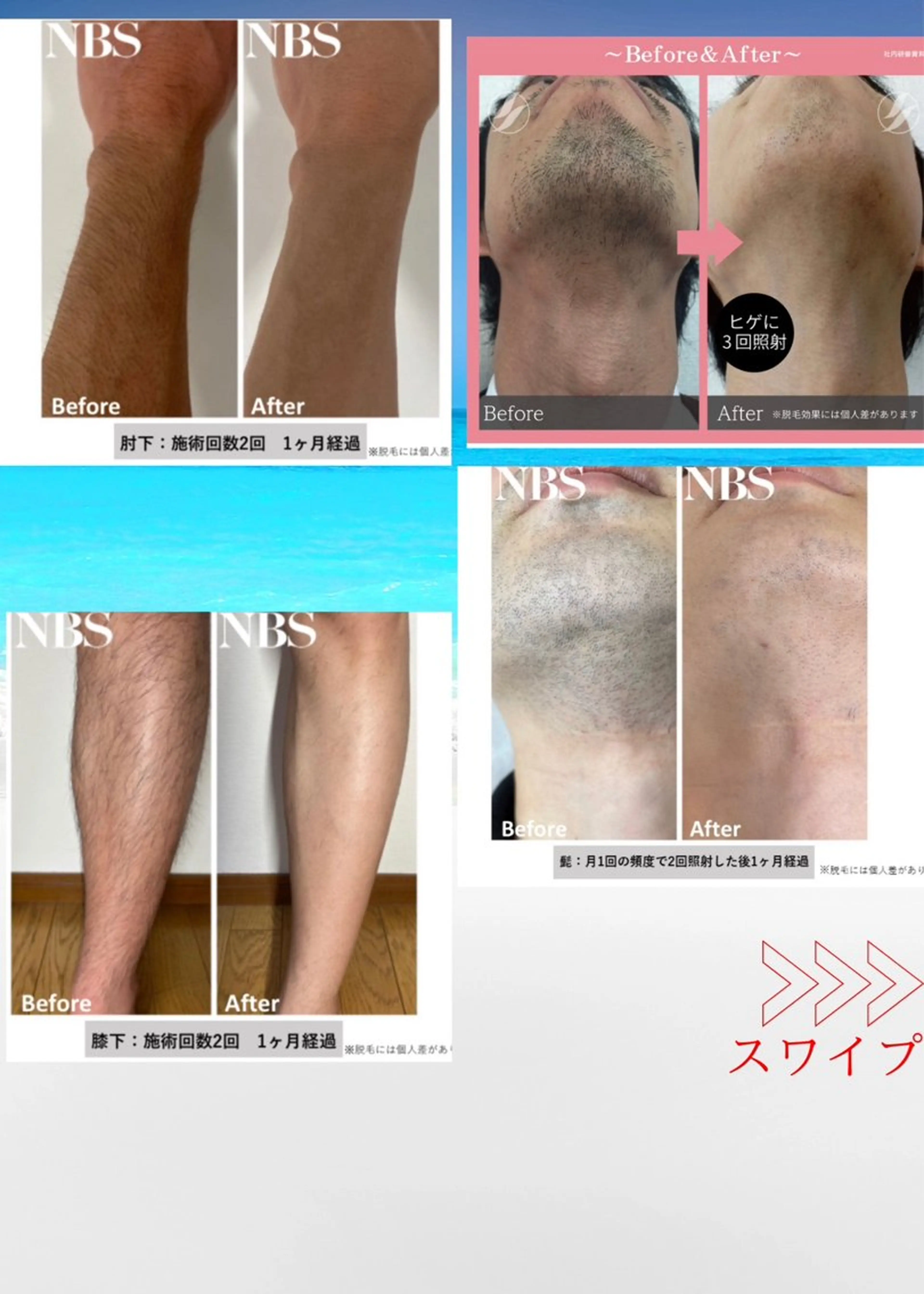 お試し脱毛　お好きな部位を1ヶ所の脱毛の写真