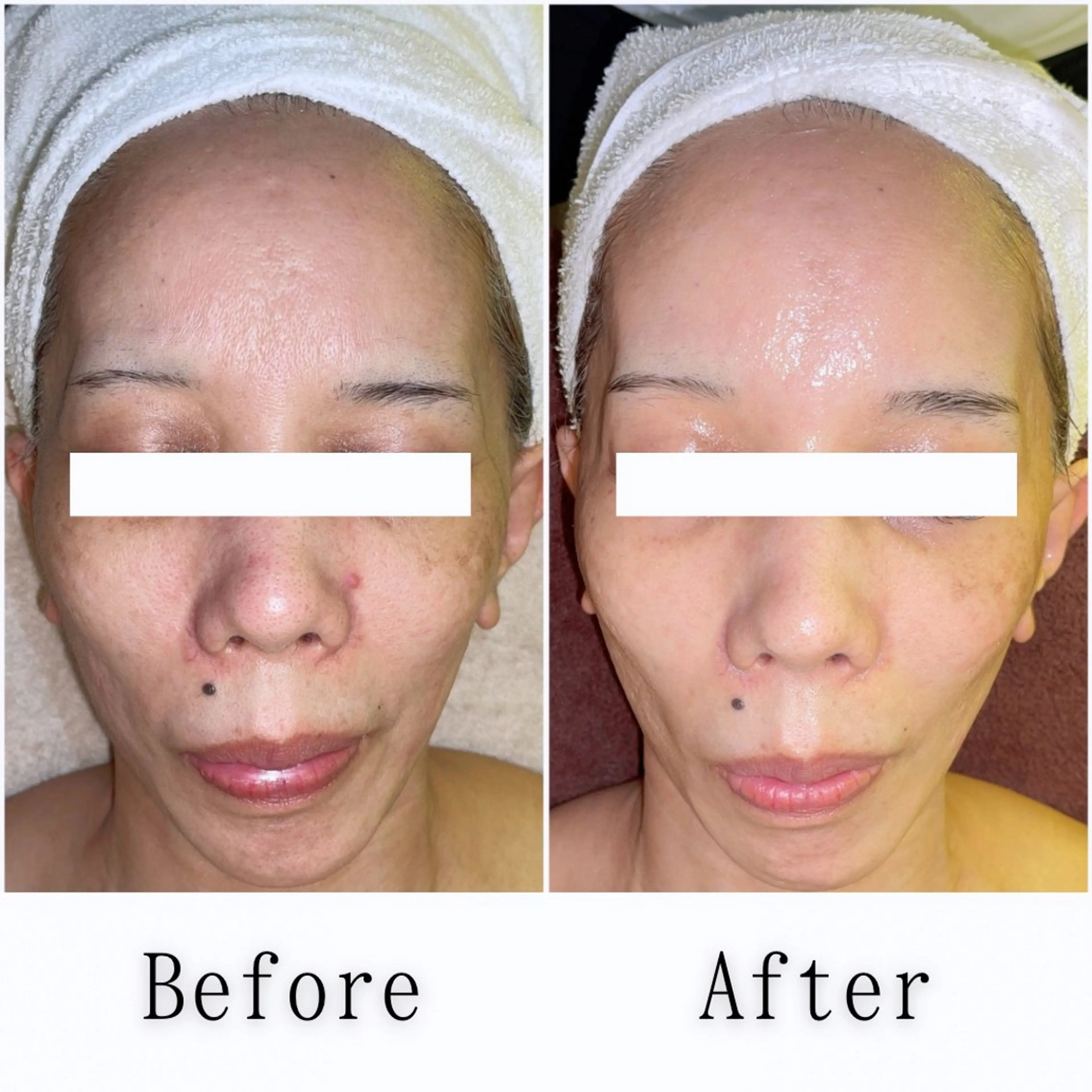 【ほうれい線/目下のたるみ/フェイスライン改善】2回目以降の写真