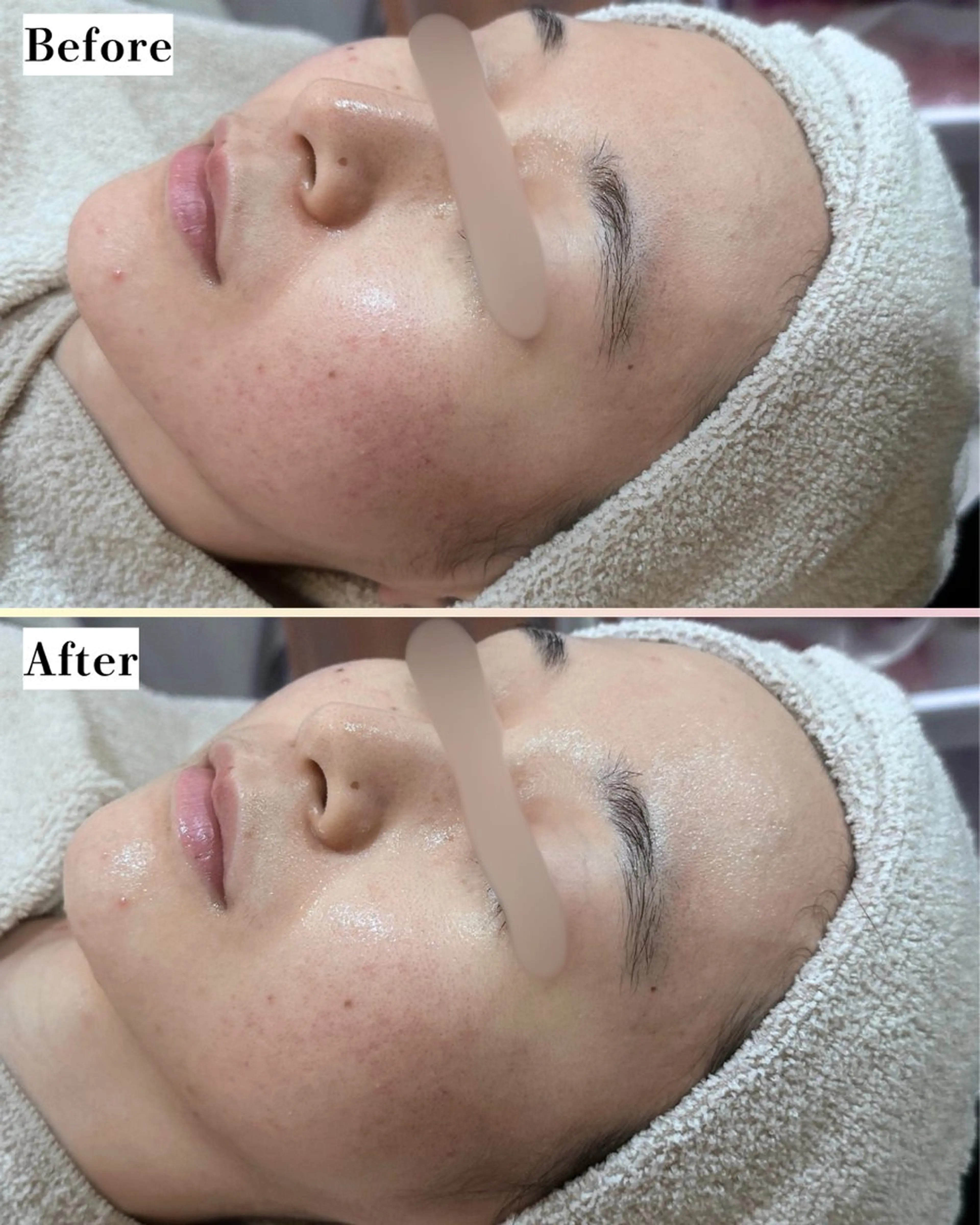 エステ |ピーリング・毛穴| soina神楽坂のエステ・リラクイメージ