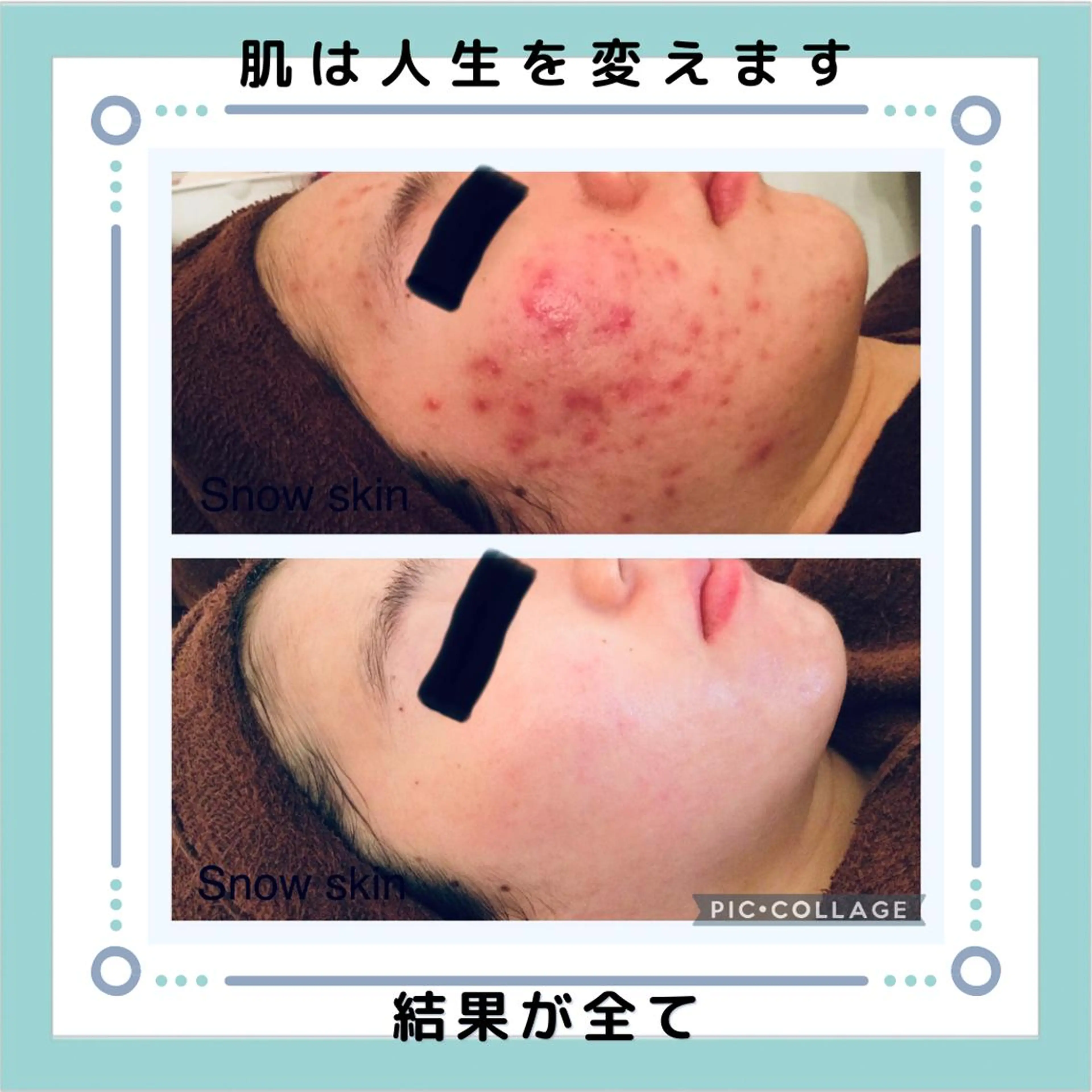 【💓感謝祭💓特許取得】部位ハーブピーリング 60分 4900円​〜​肌荒れやニキビにピンポイント！体にもOK✨剥離なしの写真