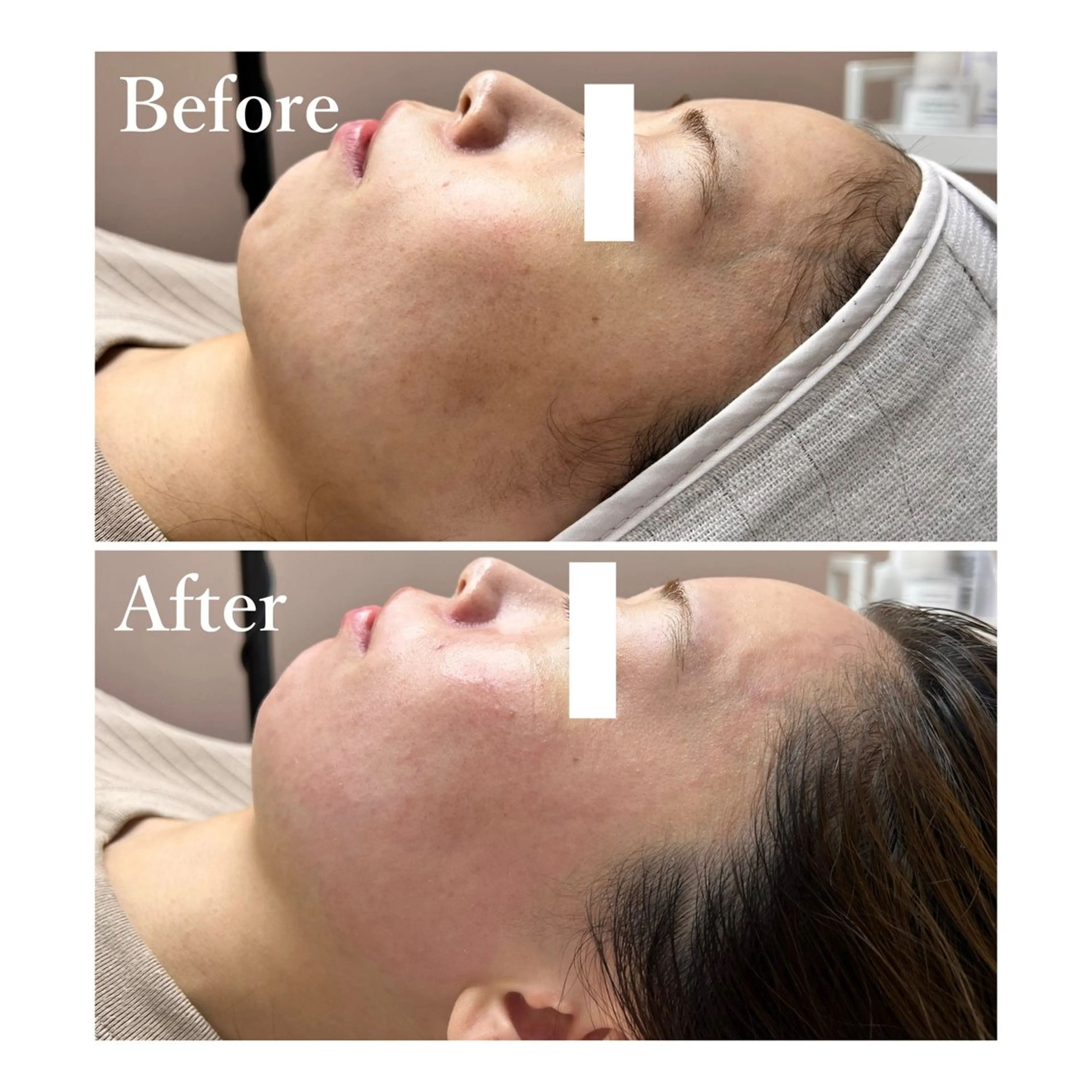 【全顔】フェイシャルwax/フェイシャルWAX/フェイスワックス/フェイスwax/フェイスWAXの写真