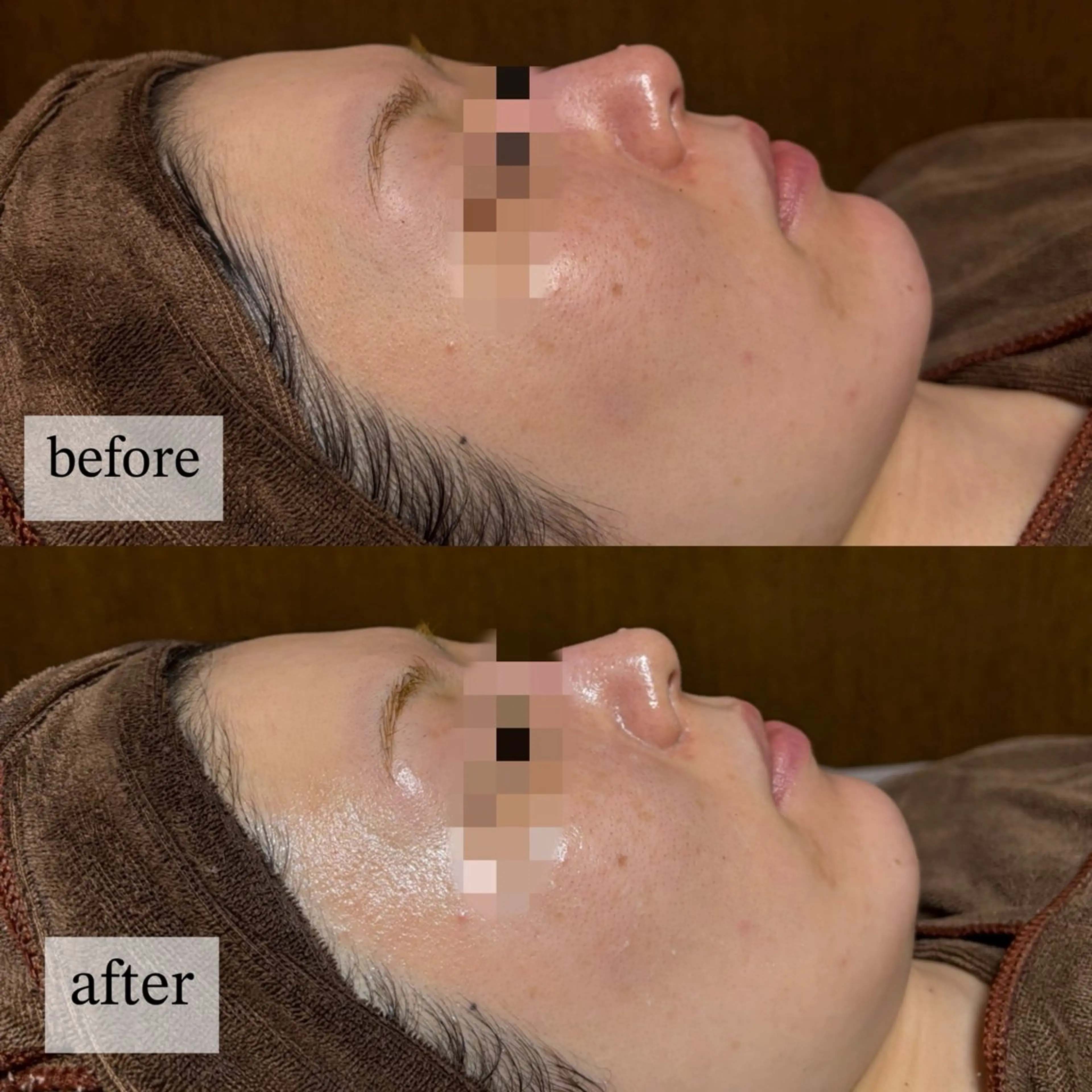 エステ HINANO矢場町店【ヒナノ】所属・脱毛/肌改善🌿 HINANO 村田のエステ・リラクイメージ