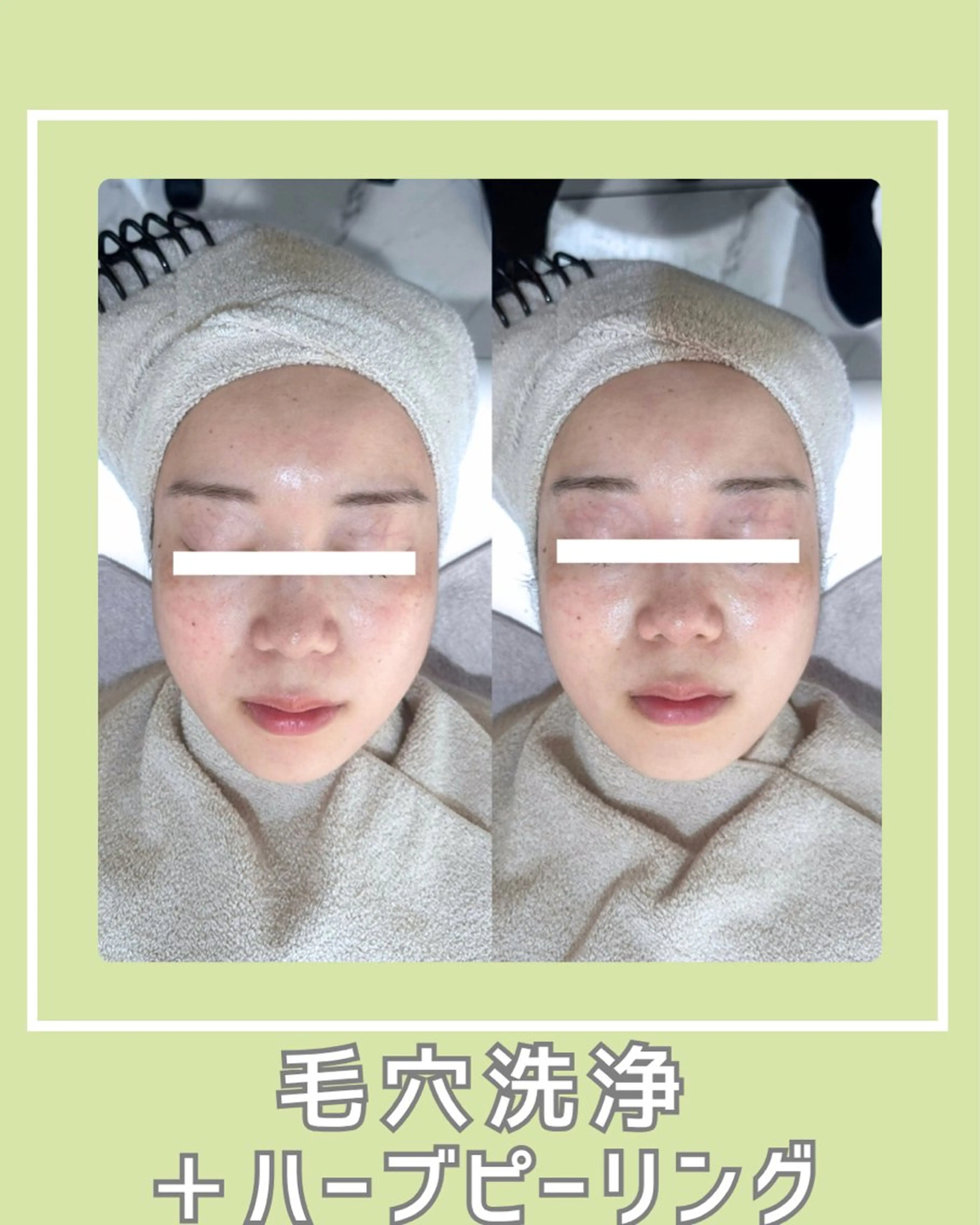 エステ |ピーリング・毛穴| soina神楽坂のエステ・リラクイメージ