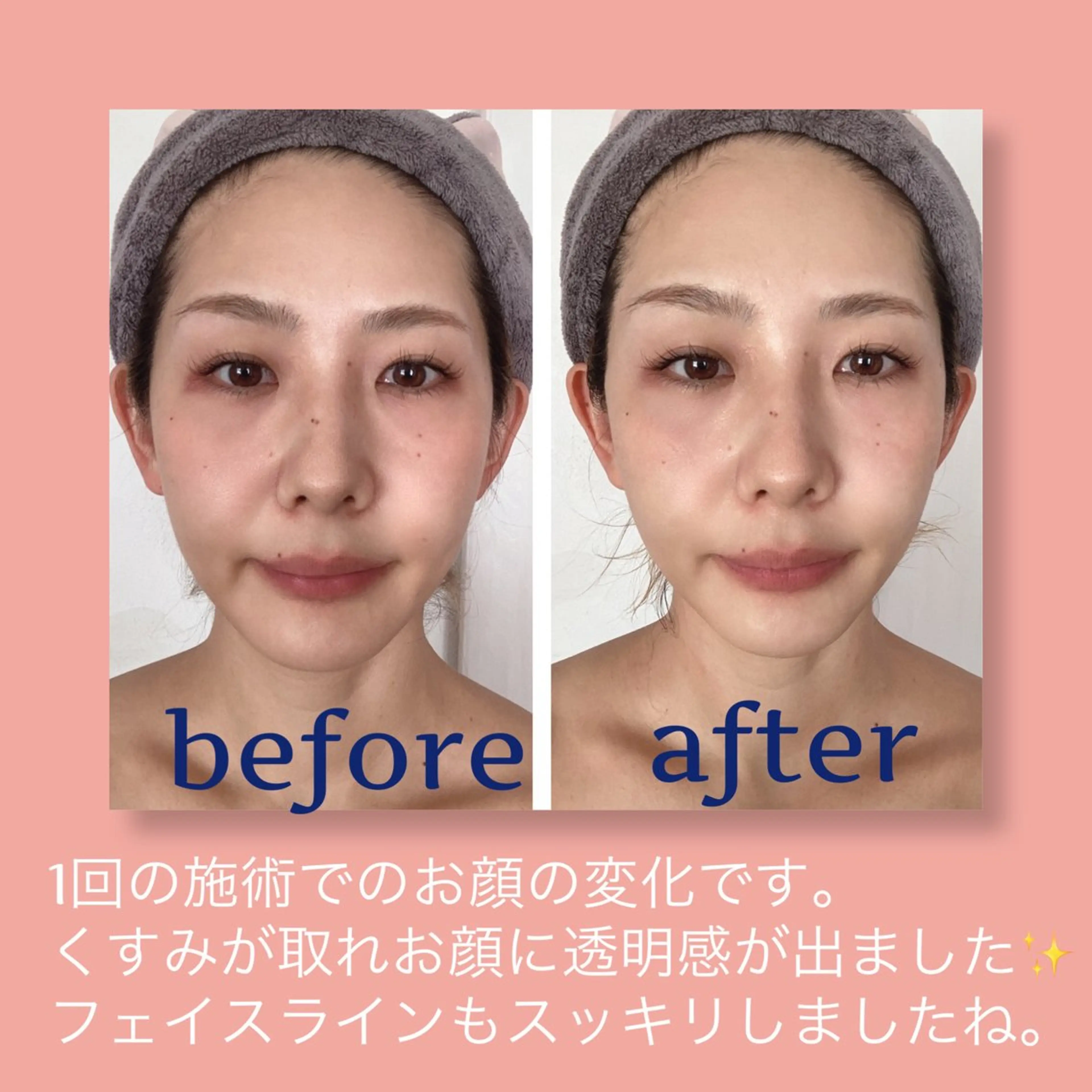 EMSでぐいっと引き上げ👶💫美顔器ありベーシックフェイシャルトリートメント💆‍♀️✨✨の写真