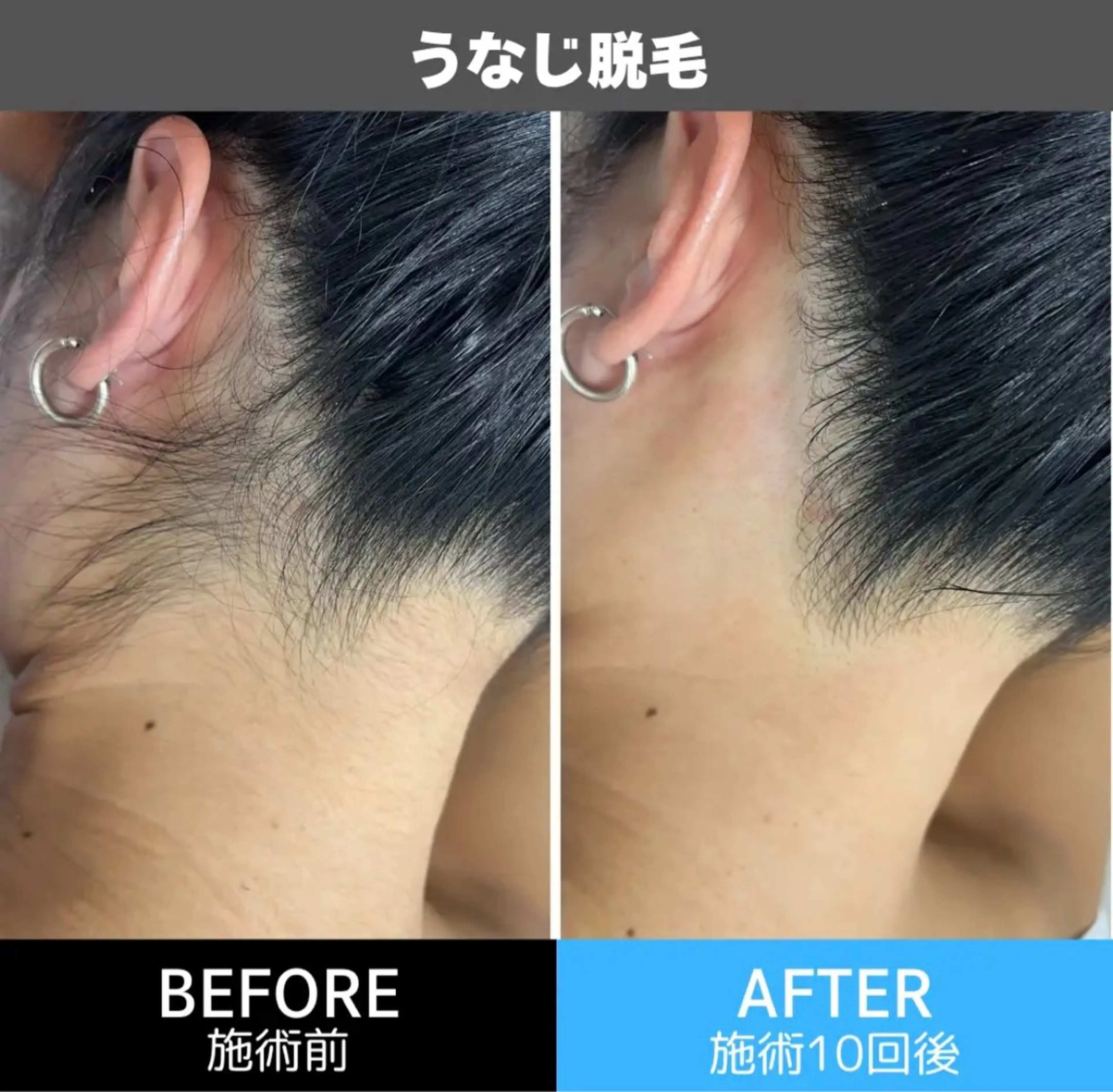 【レディース うなじ脱毛】の写真