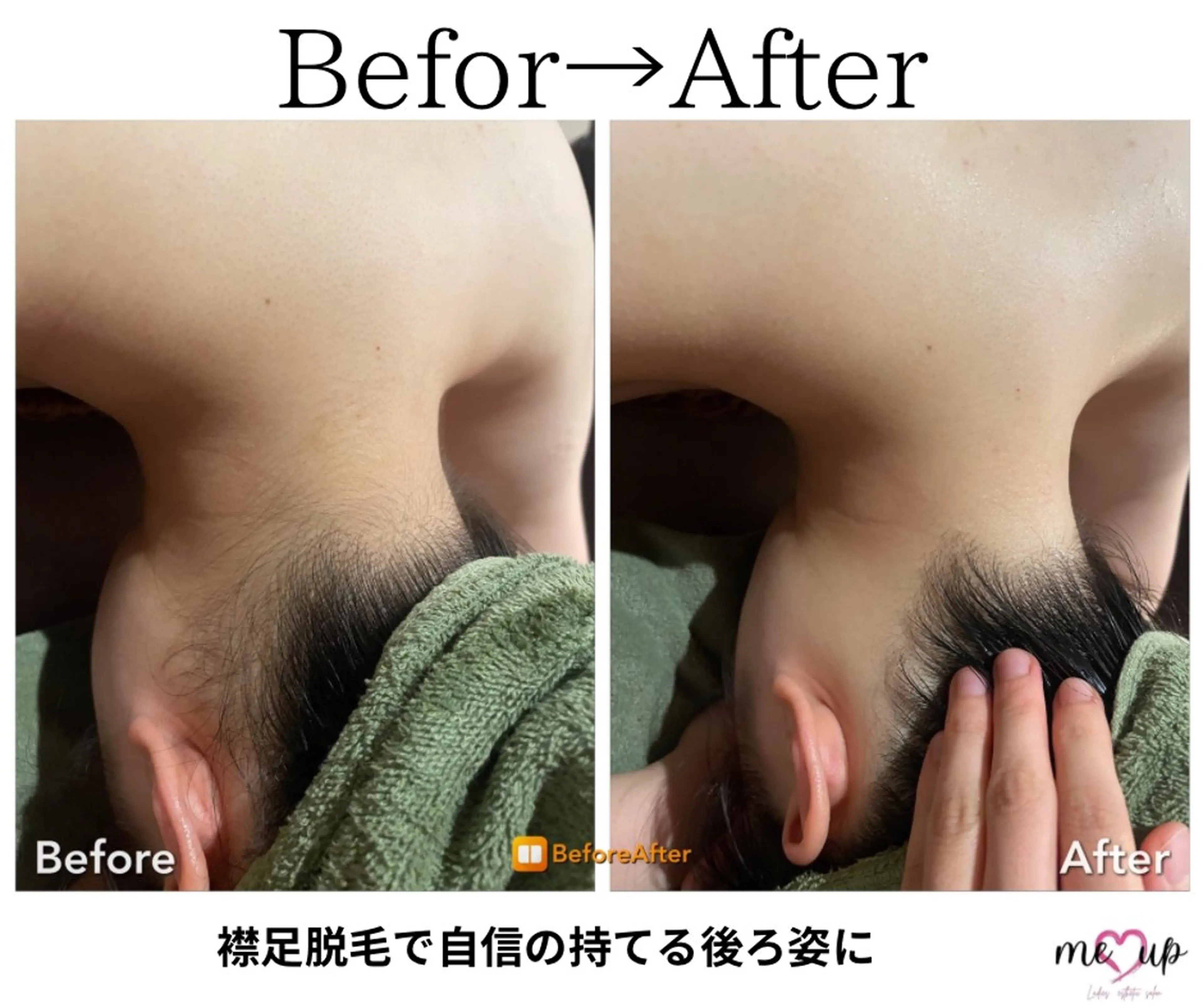 脱毛 Meupニキビ専門店 背中/ハーブ/肌管理のその他イメージ