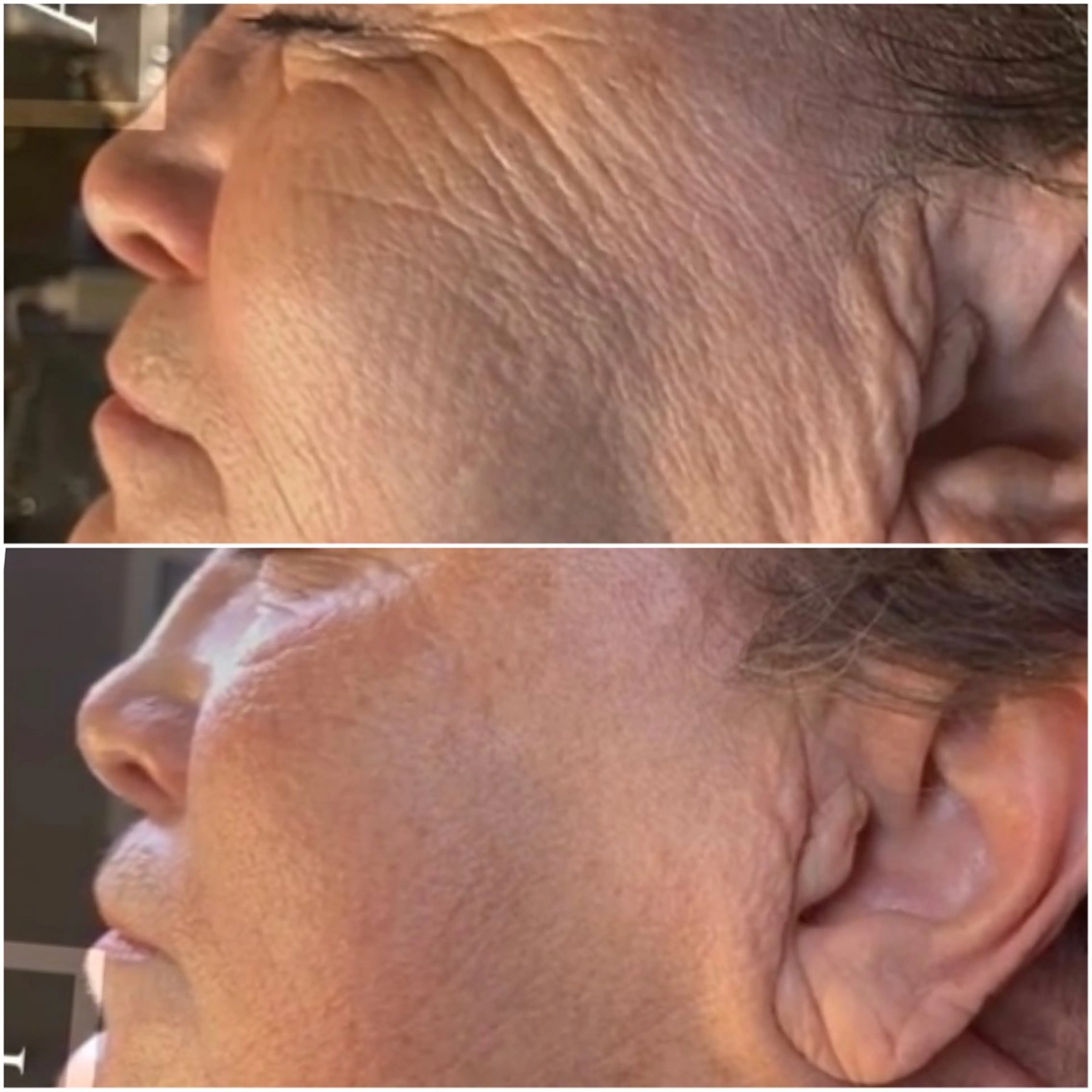 プロセルセラピーズ（顔）✨クレーター、赤ら顔、毛穴、しわ、たるみ、しみ等々🙆‍♀️10回のエステより1回のプロセル👍の写真