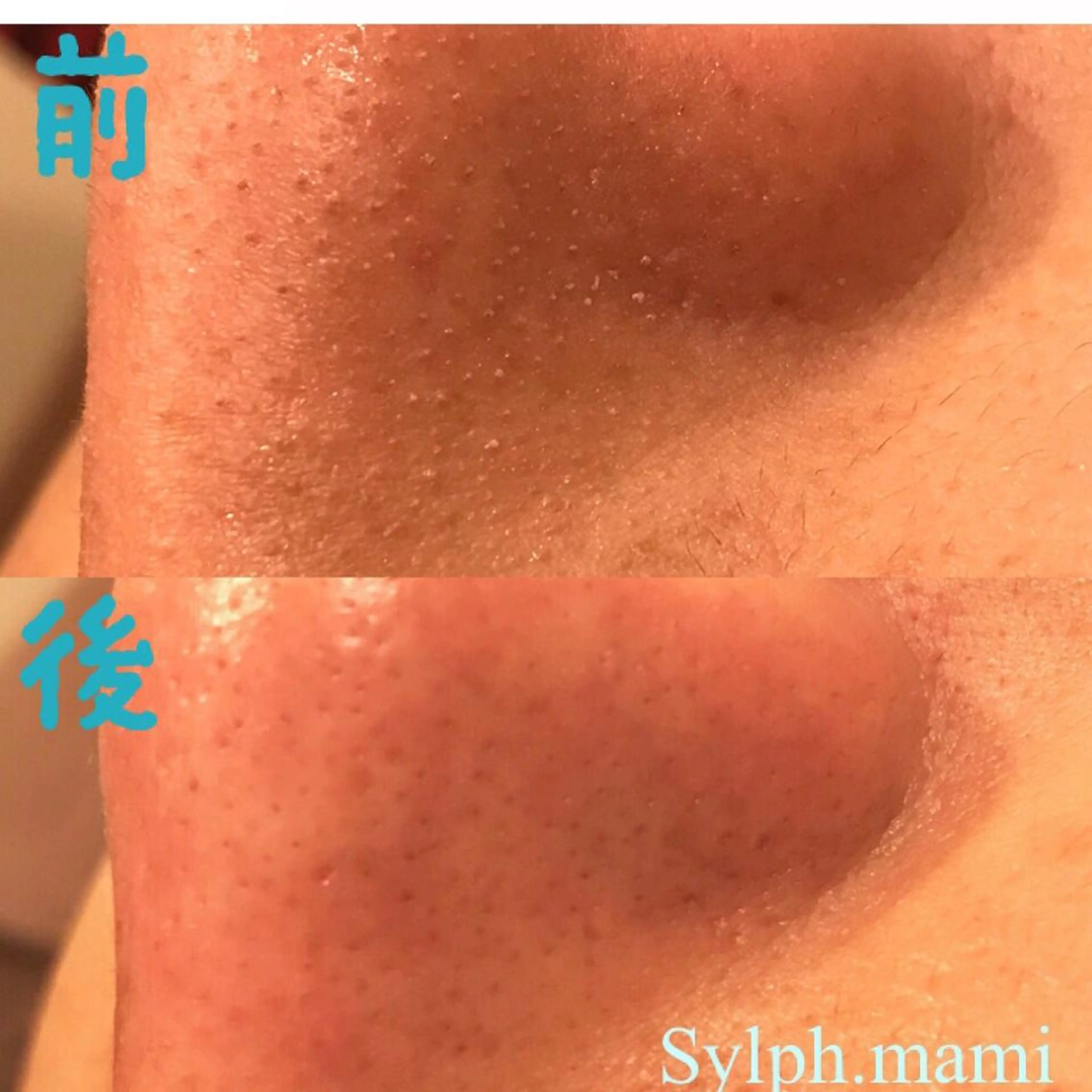 【鼻のプチエステ】黒ズミ&角栓除去‼️開いた毛穴の徹底集中ケア✨の写真