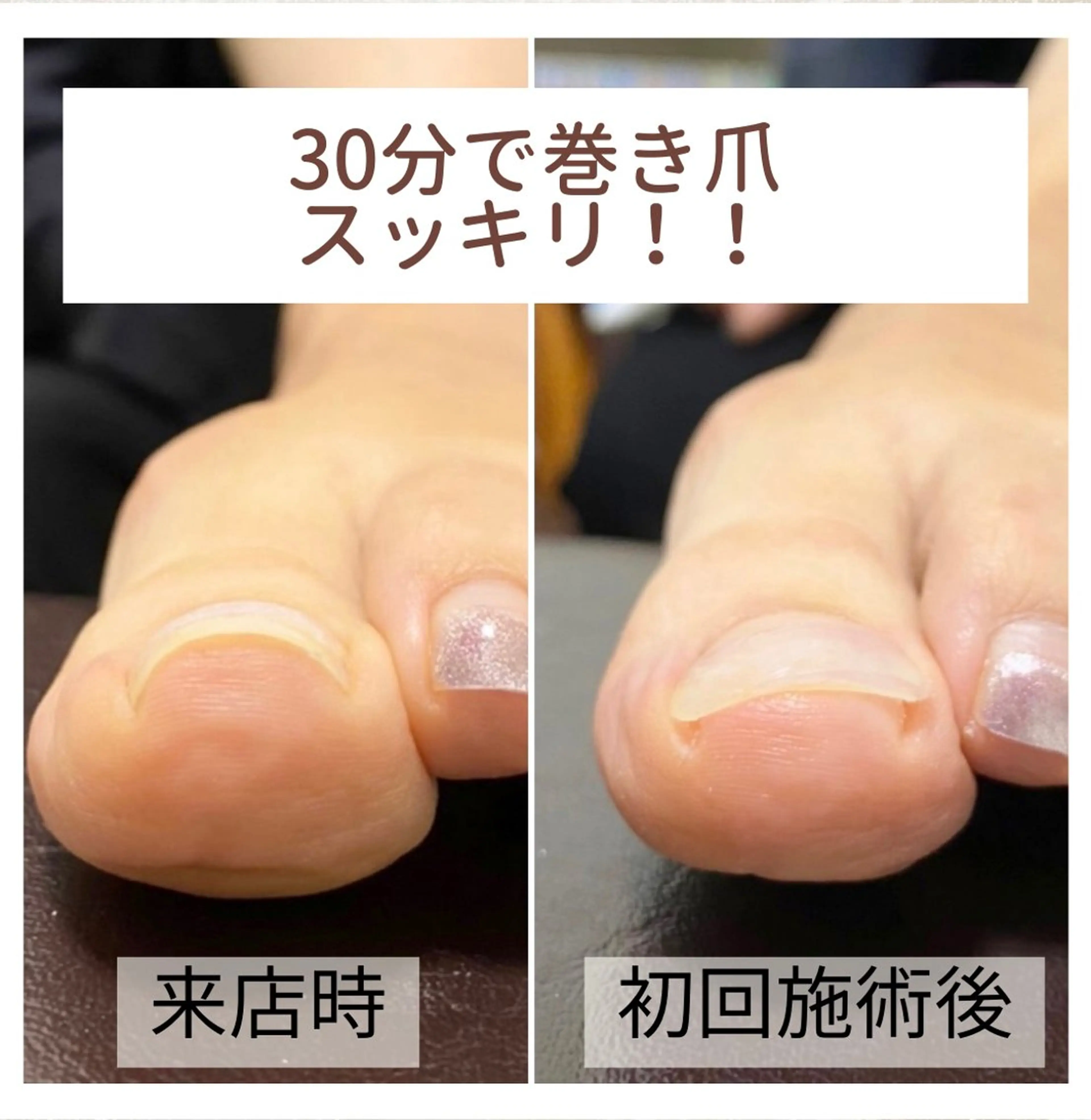 ネイル 深爪・巻き爪 専門サンセリテのネイルデザイン