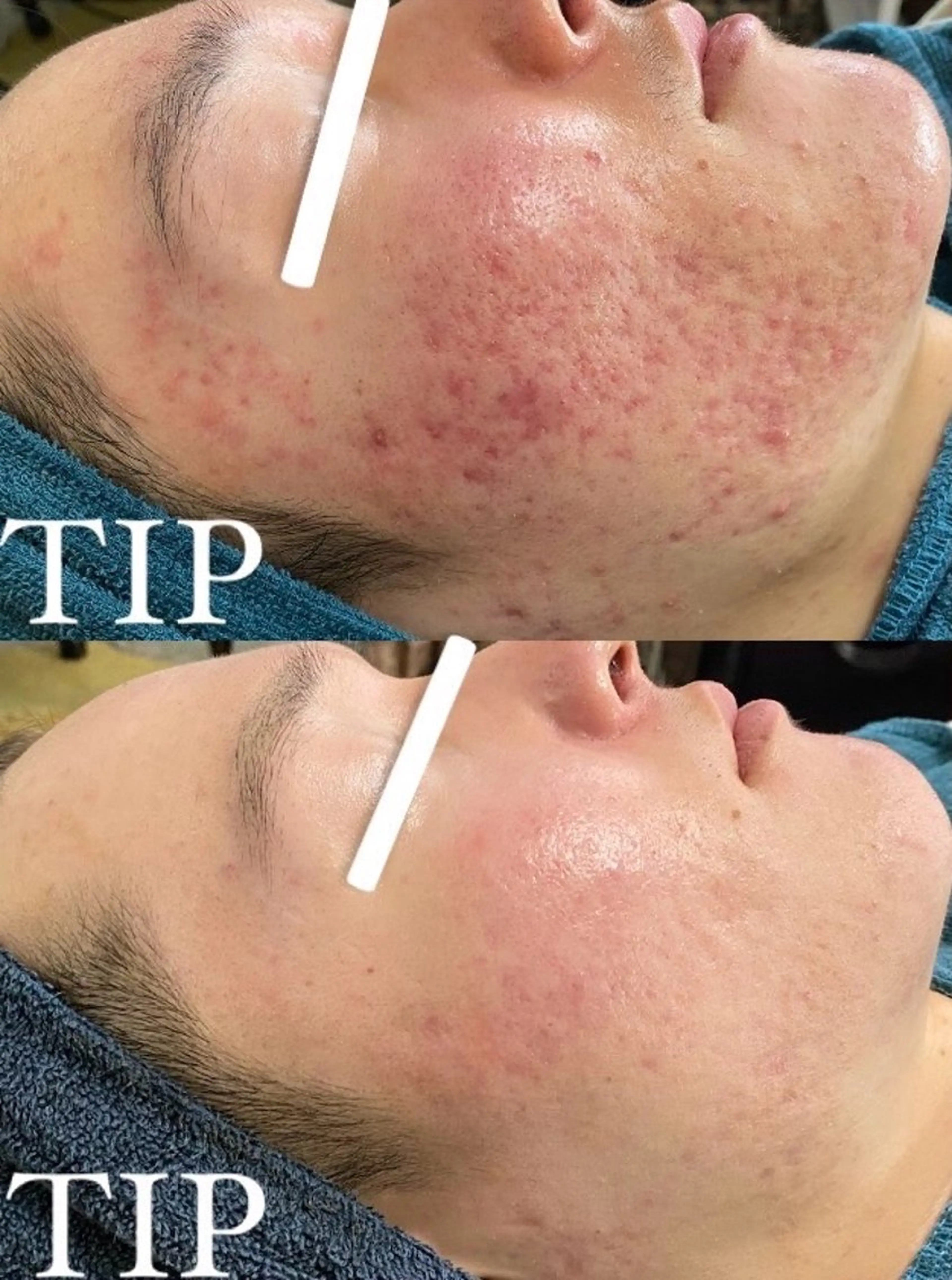 医療提携🫧ハイレベル💎TIPハーブピーリングの写真