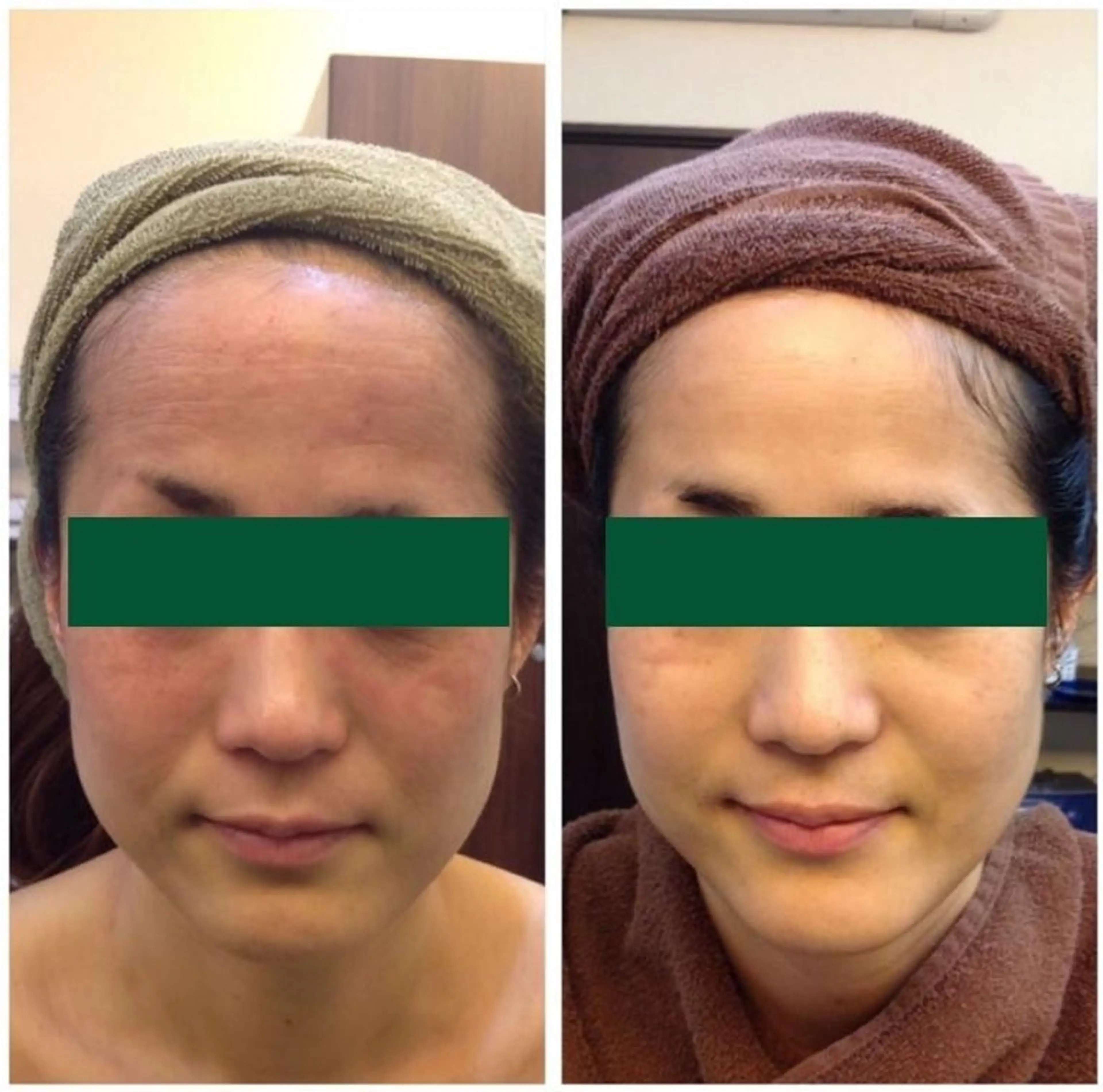 漢方ハーブピーリング(エイジングケアコース)の写真