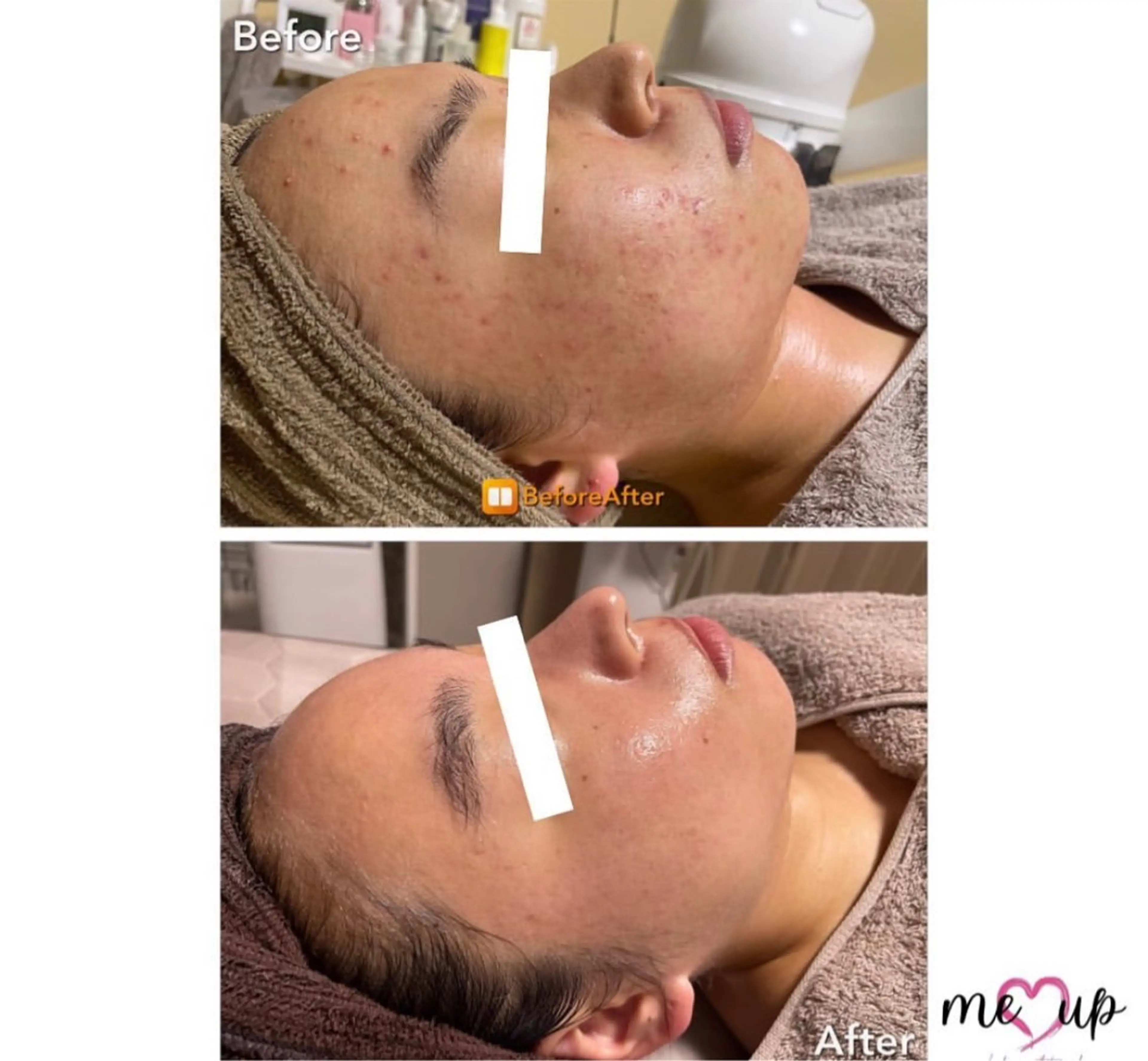 Meupニキビ専門店 背中/ハーブ/肌管理のその他イメージ