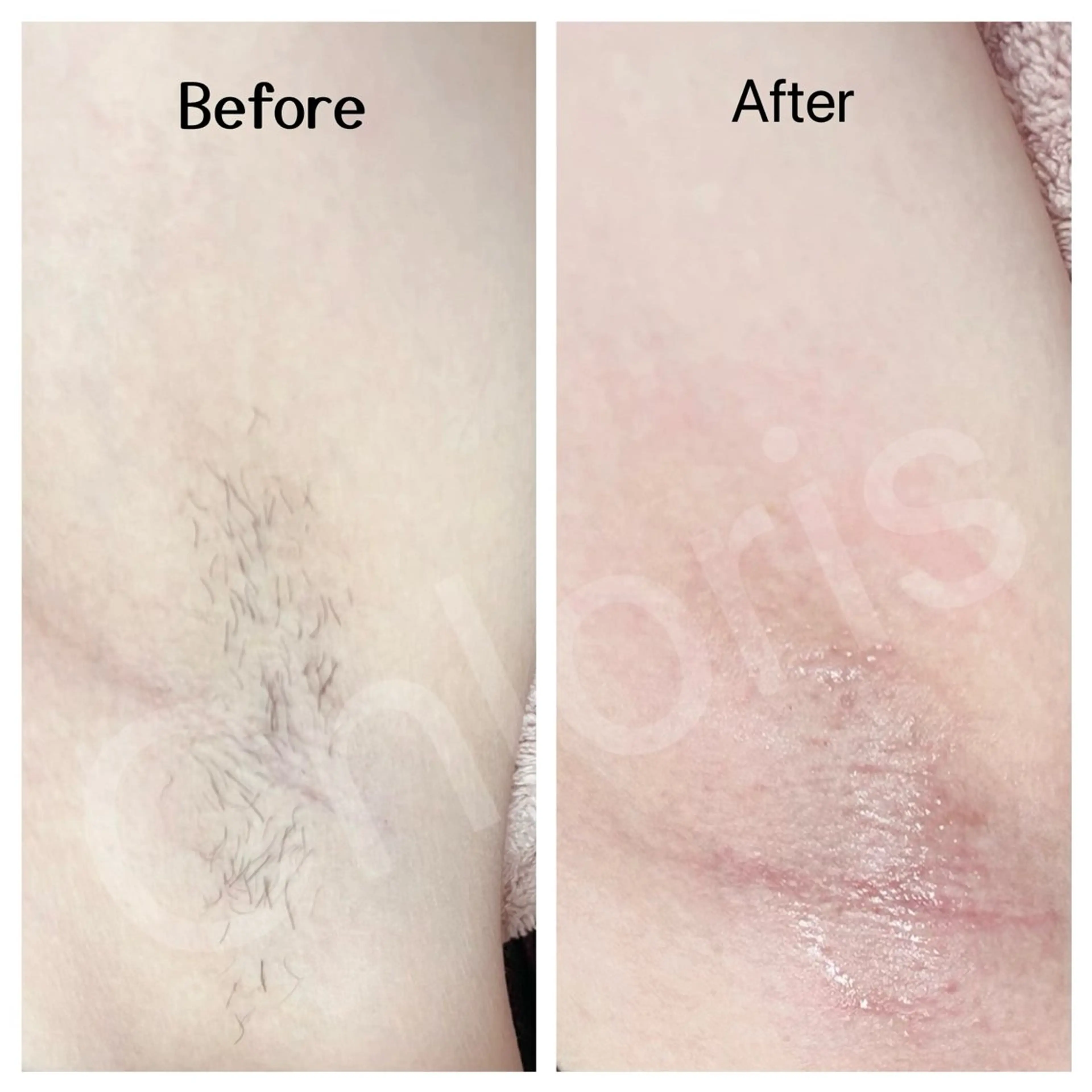 川越ローマピンク 光脱毛＆ワックス脱毛のエステ・リラクイメージ