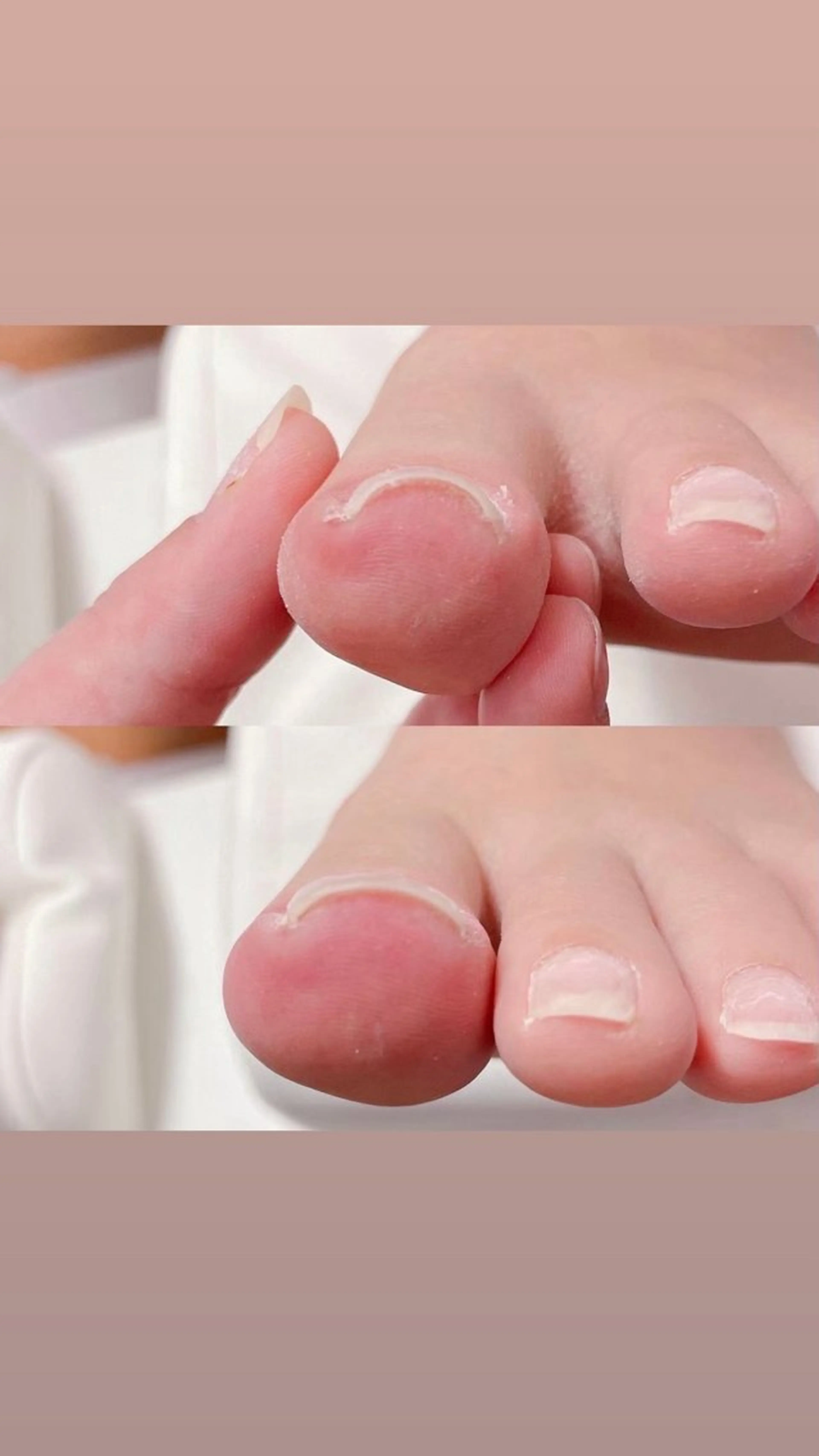 【初回限定】巻き爪ケア（親指2本）｜4,980円👉 歩くのがラクになる巻き爪ケア ✨の写真