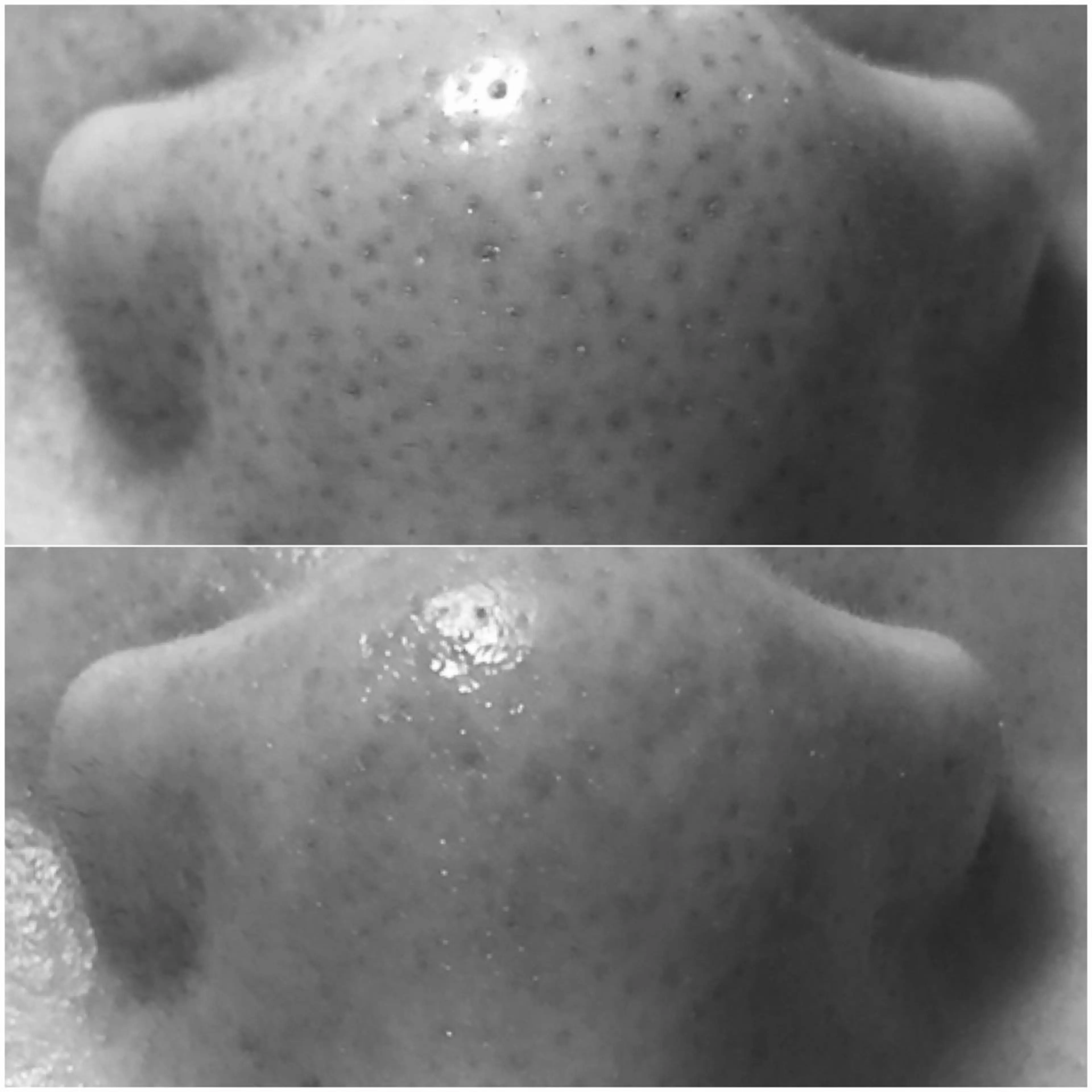 【いちご鼻•つまり毛穴👃鼻頬顎】毛穴洗浄＋超鎮静パックの写真