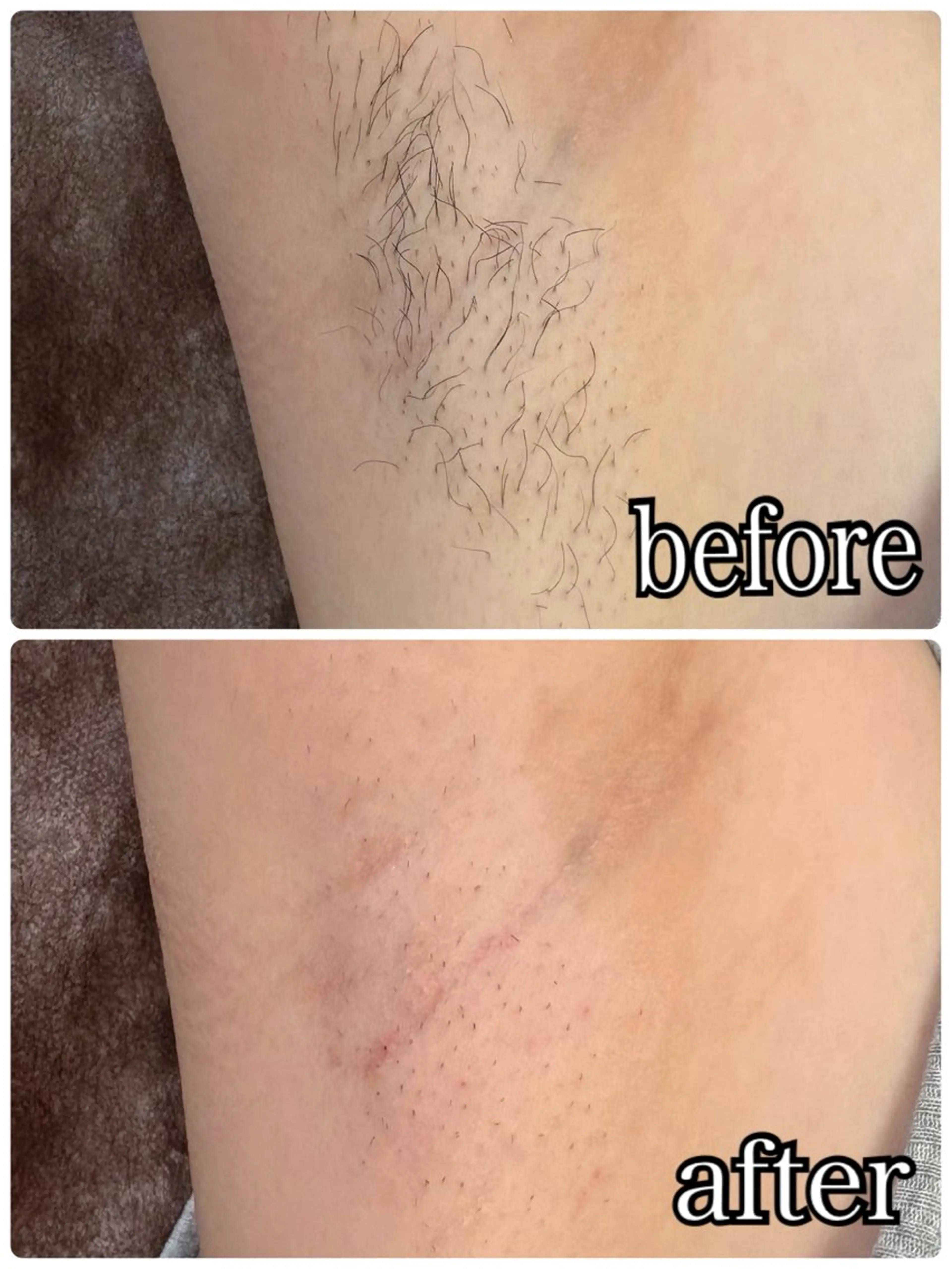 脱毛 mysig Fumiのエステ・リラクイメージ