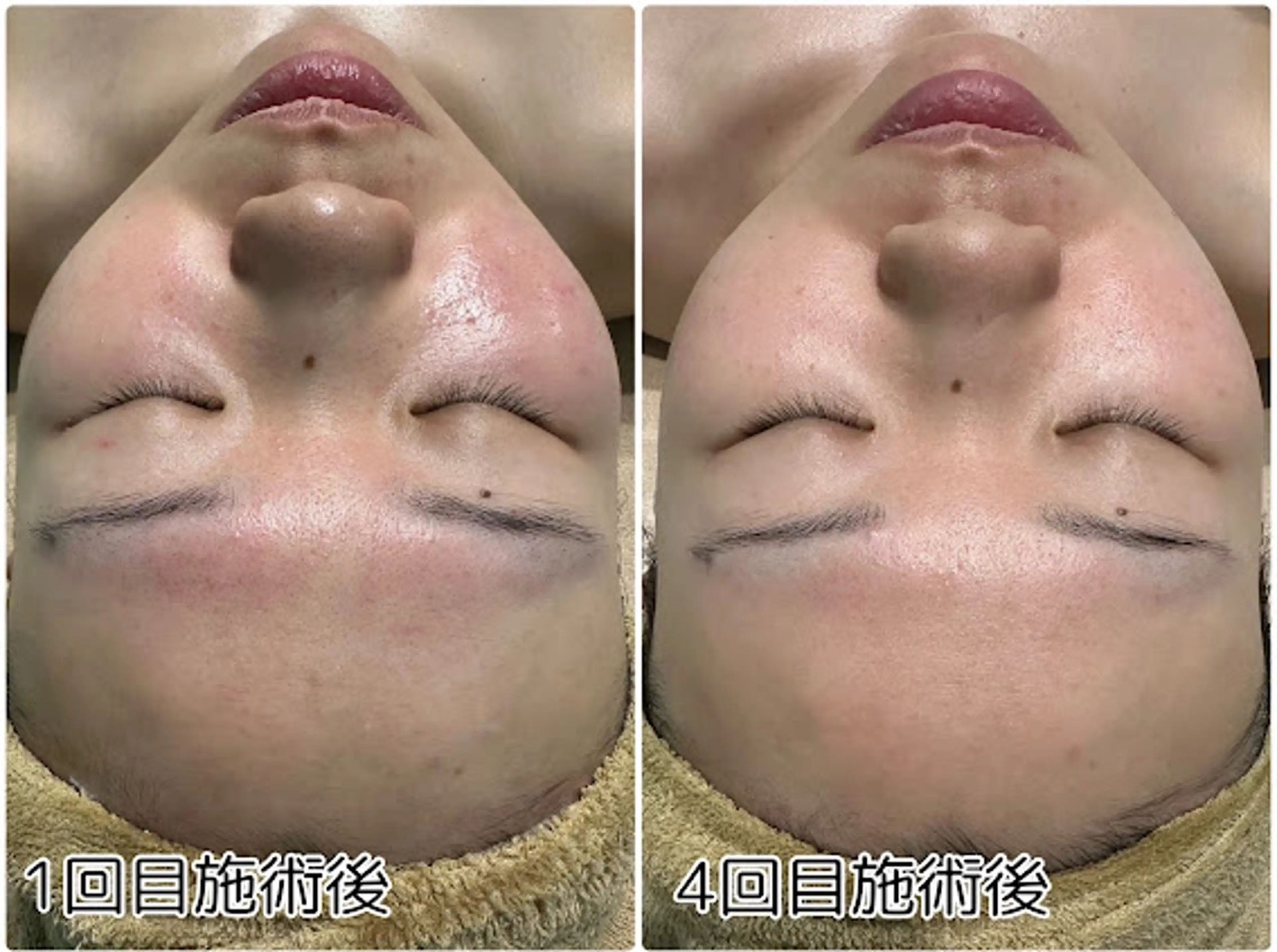 剥けないハーブピーリング🌿ダウンタイム無し！施術後直ぐに化粧OK🙆‍♀️の写真