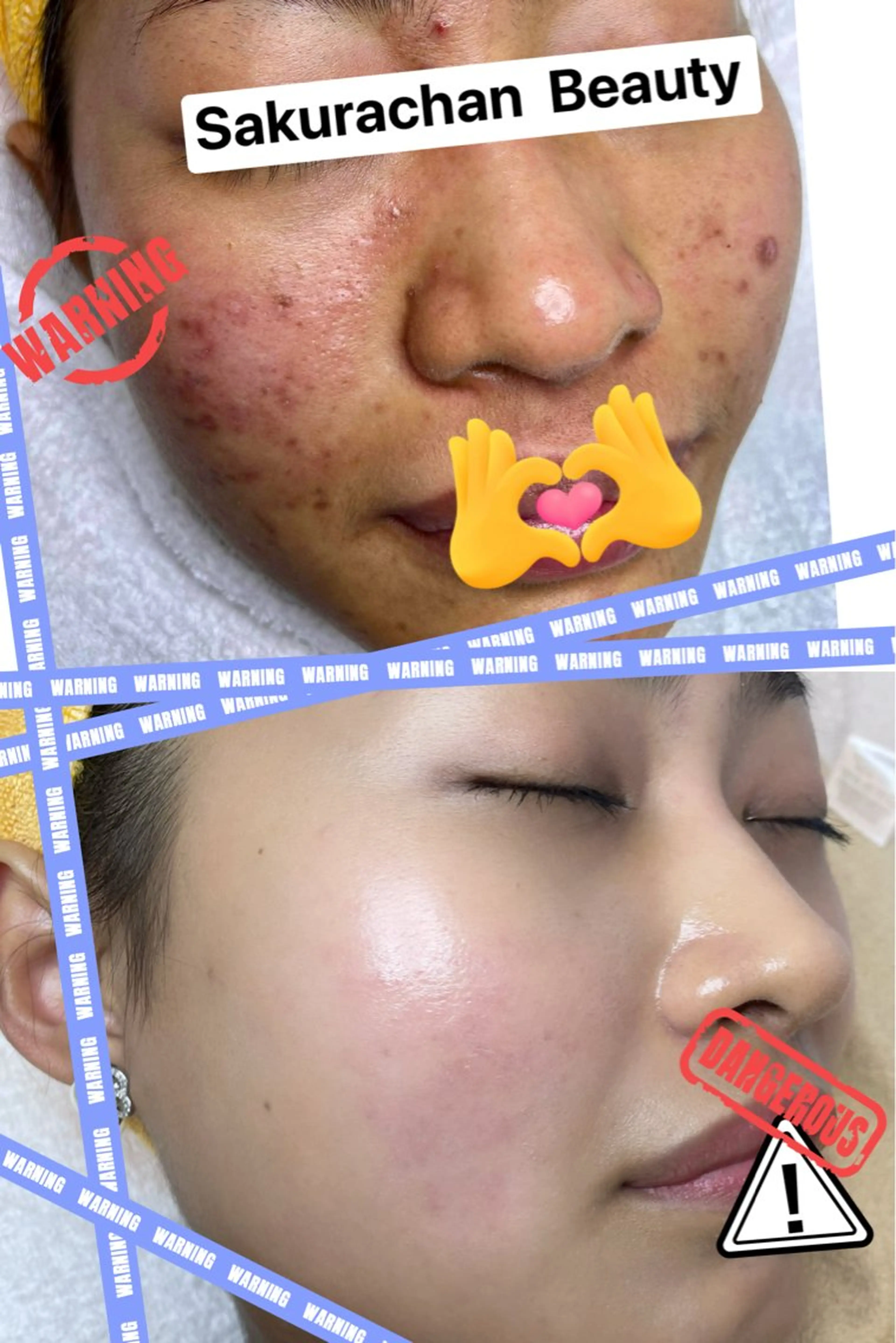 【SALE】各種ニキビ肌，肌荒れ，赤ら顔，敏感肌ケア(特別毛穴洗浄＋ヘッドスパも含む)の写真