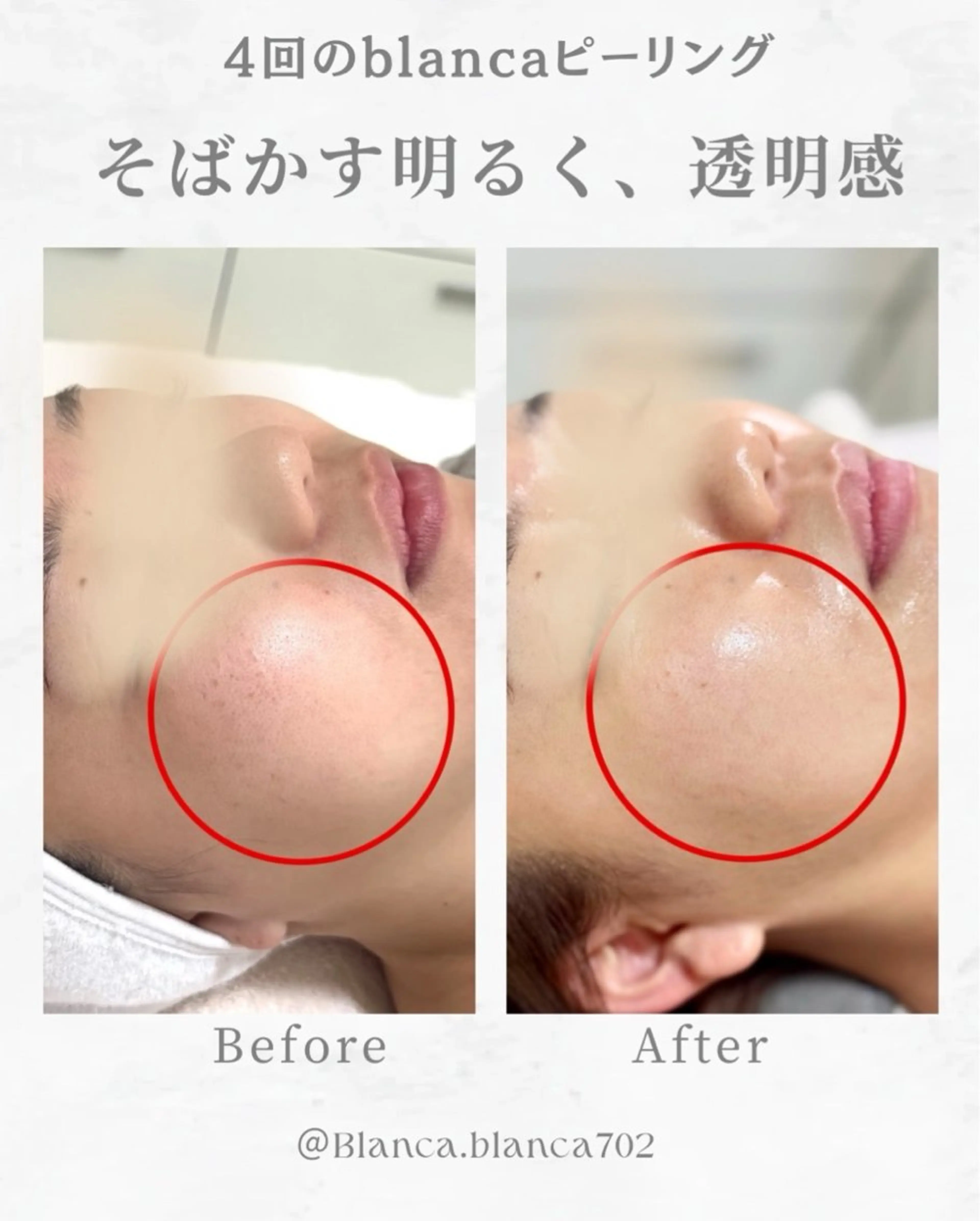 肌管理✨水光肌ピーリング(エクスビアンス)。デコルテマッサージ15分の写真