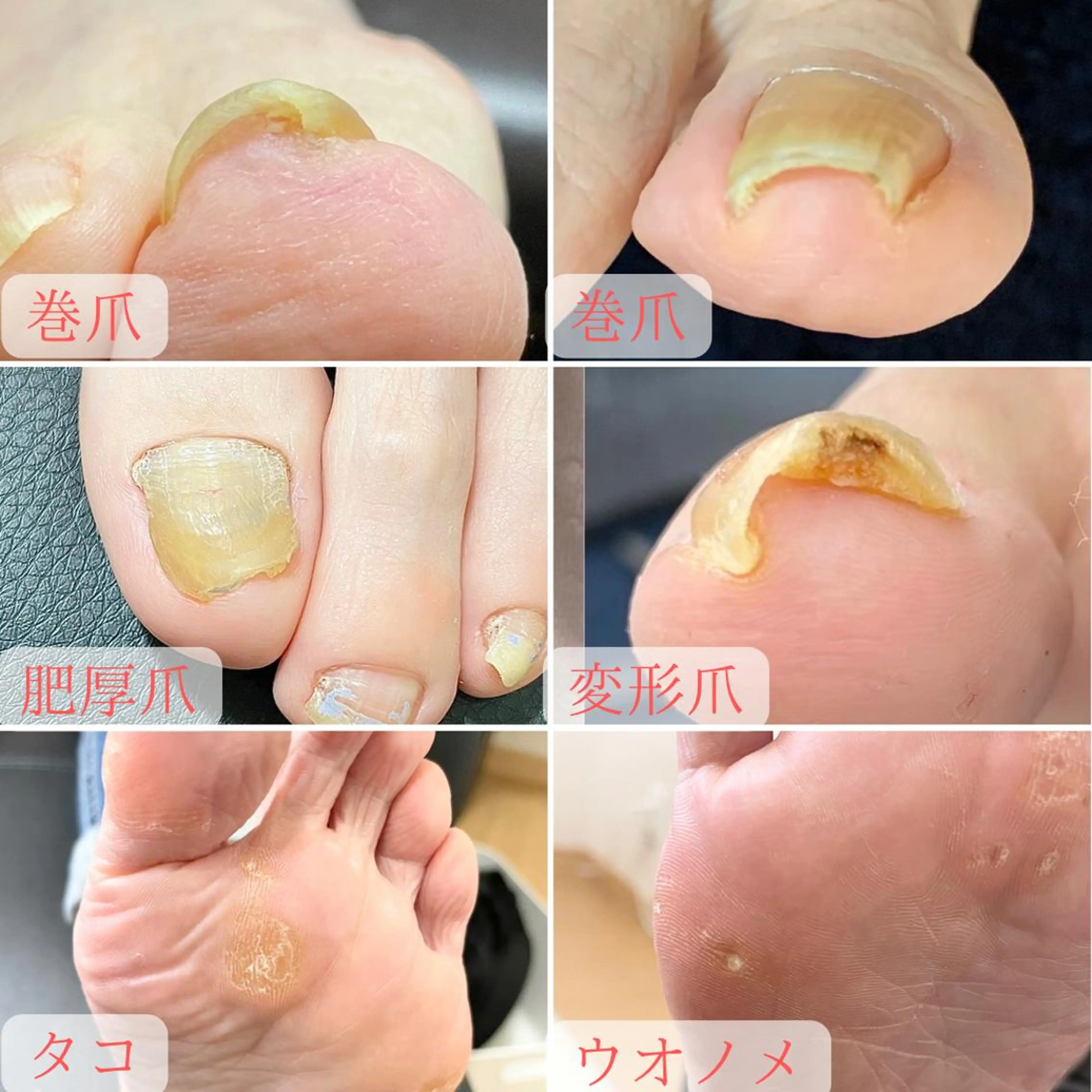 ネイル 深爪・巻き爪 専門サンセリテのネイルデザイン