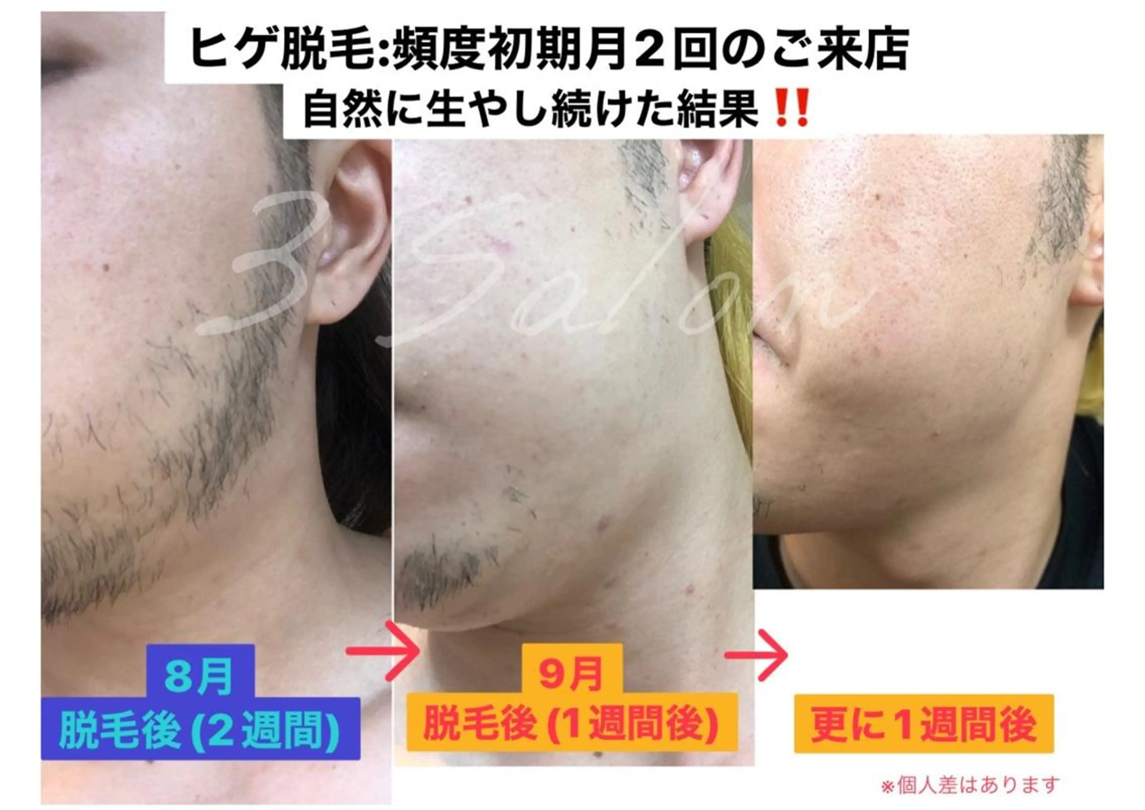 【顔脱毛】女性が気になる口周りも！男性はマナー＆新常識に！の写真