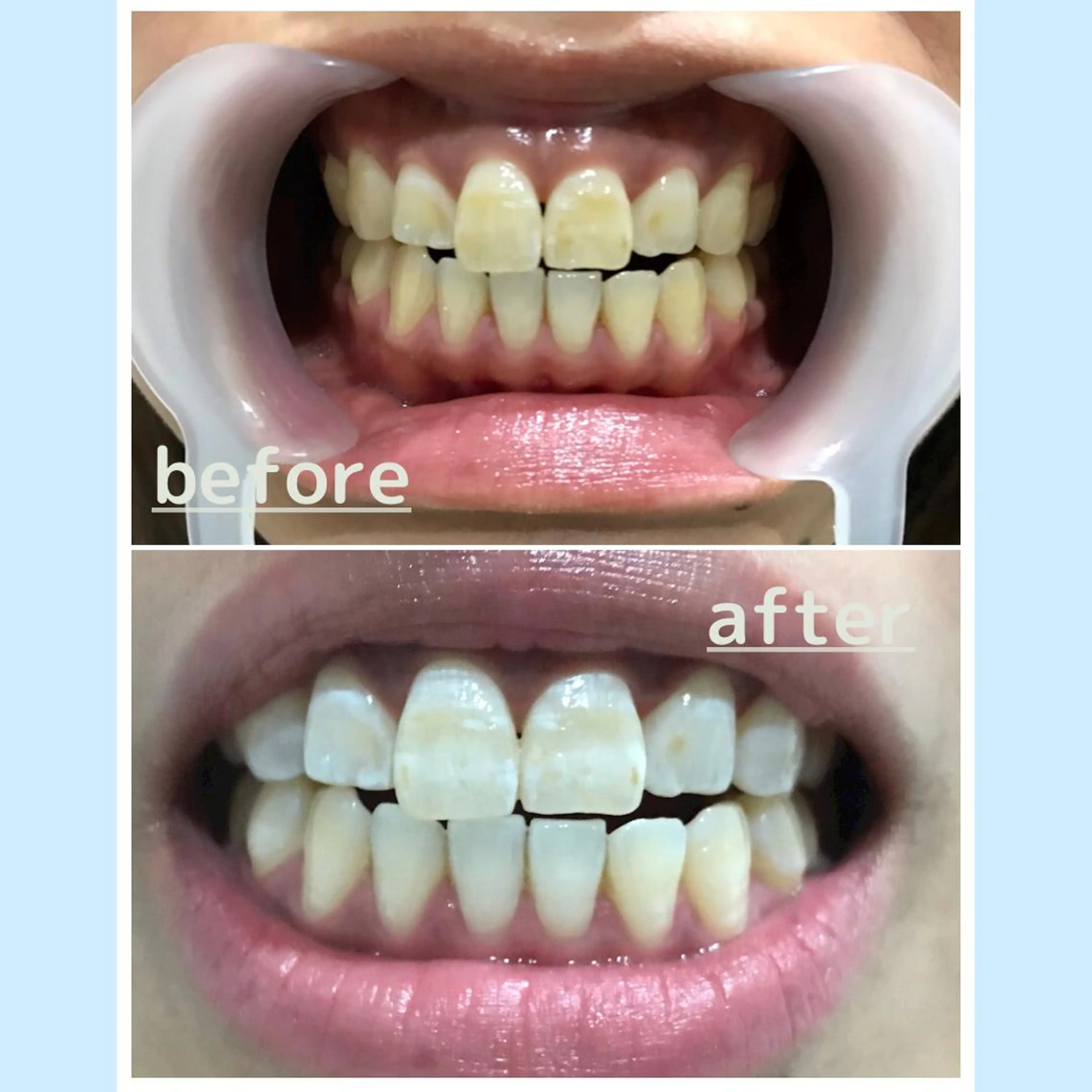 【学生限定】セルフホワイトニング初回お試し通常¥3500→¥2500💐の写真