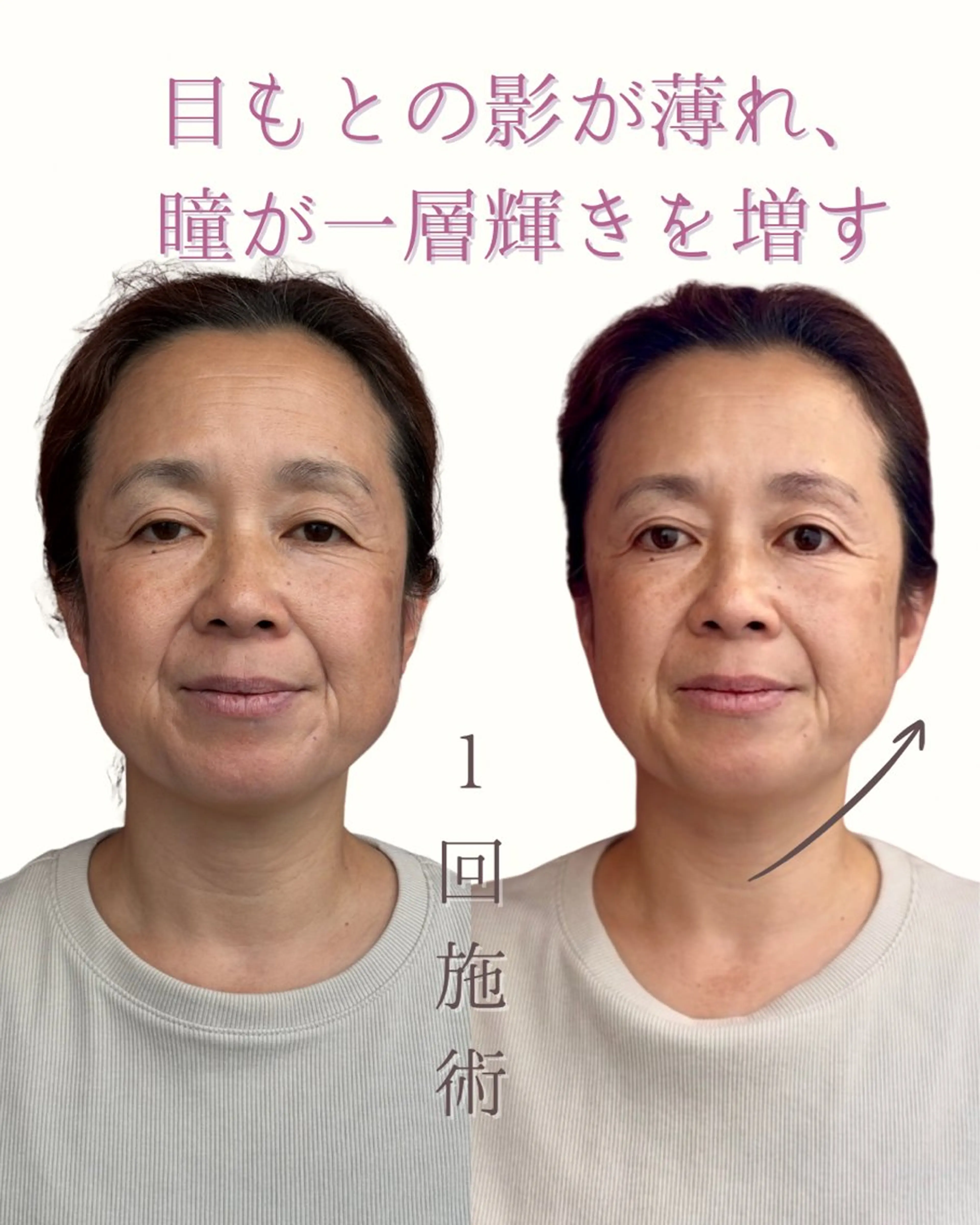 麻布十番/圧倒的小顔 毒出し美容🎀鍼灸のその他イメージ