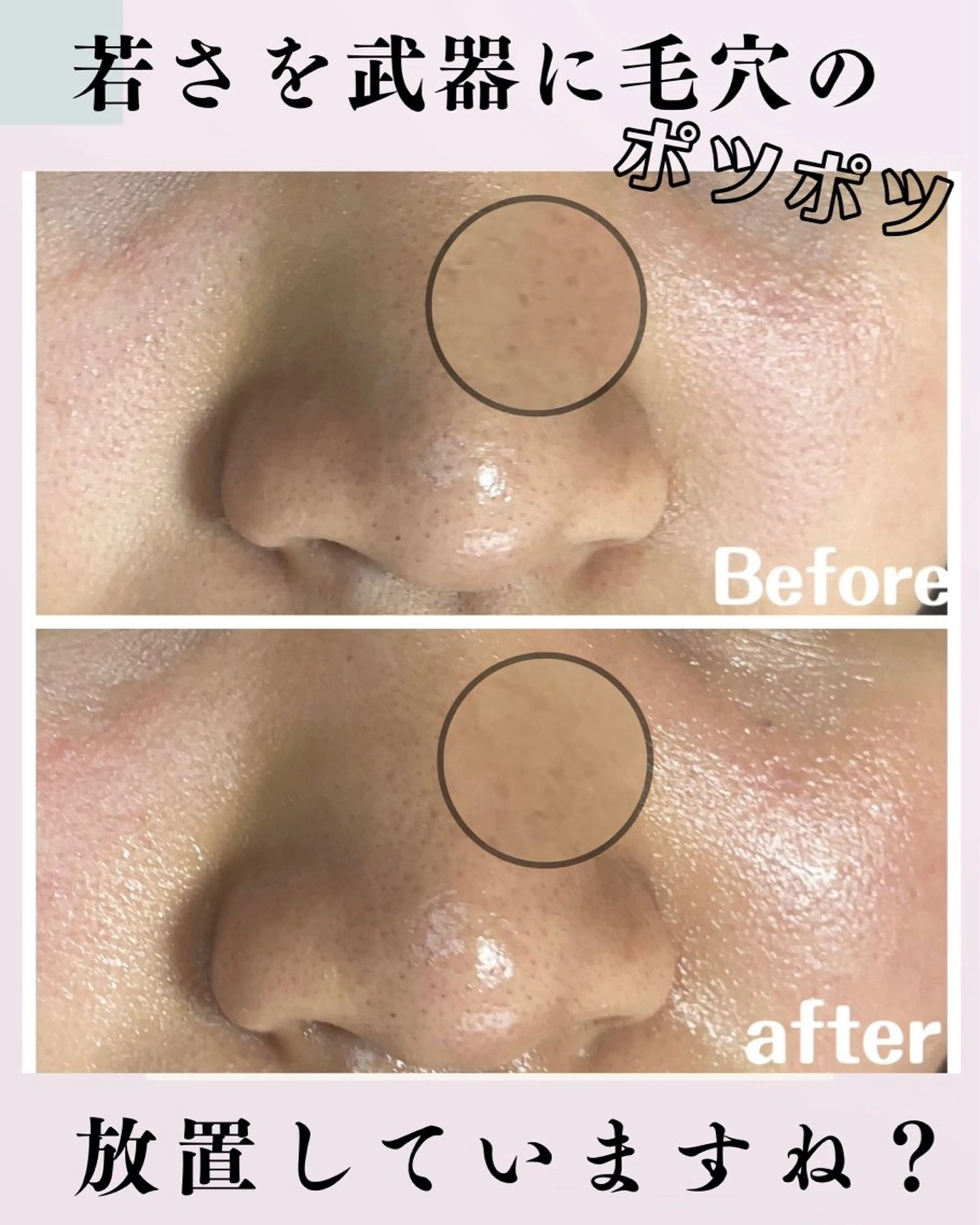 学生なら全員割引！【学割U22】毛穴洗浄　ミニモ学割の写真