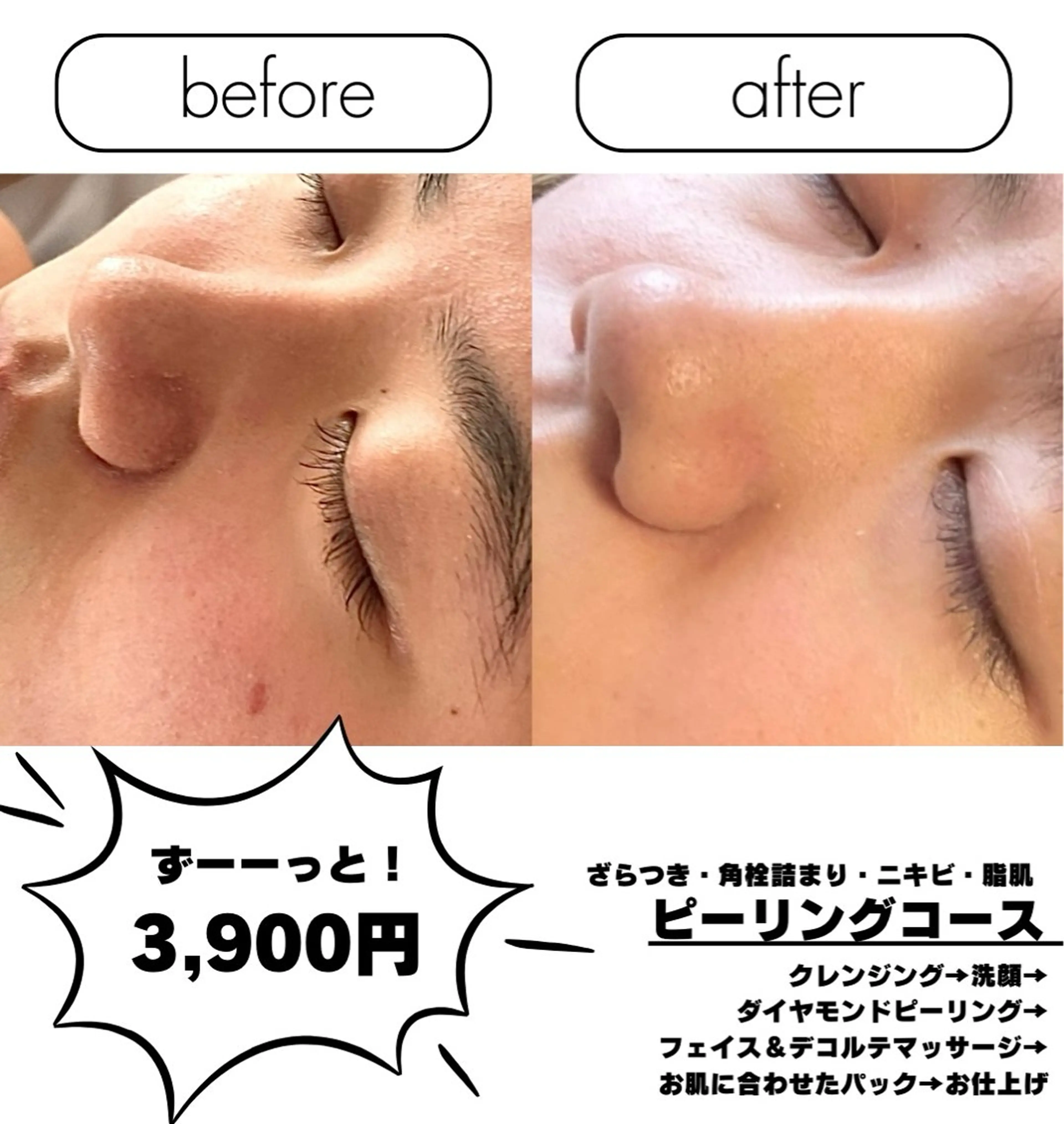 【毛穴/角質/ニキビケア】潤いスキンケアコース+ダイヤモンドピーリング角質オフ60分の写真